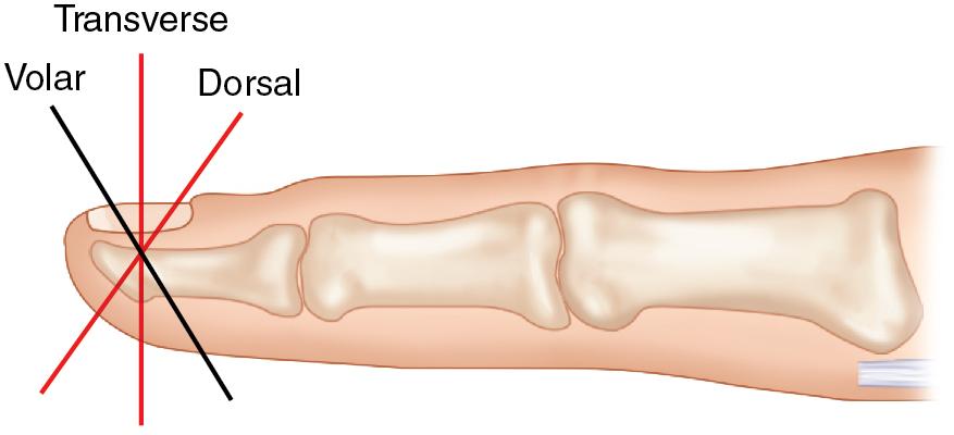 FIGURE 87.1, Transverse or dorsal oblique fingertip amputations are good candidates for V-Y advancement flap.