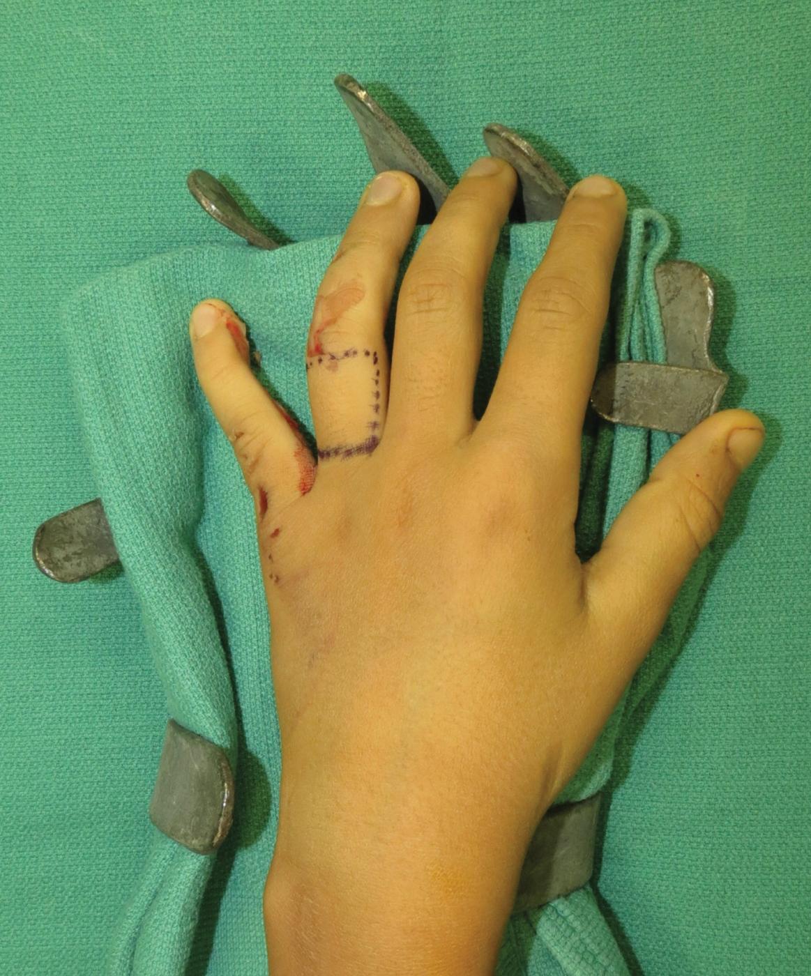 FIGURE 87.12, Flap is designed on the finger adjacent to the injury site.