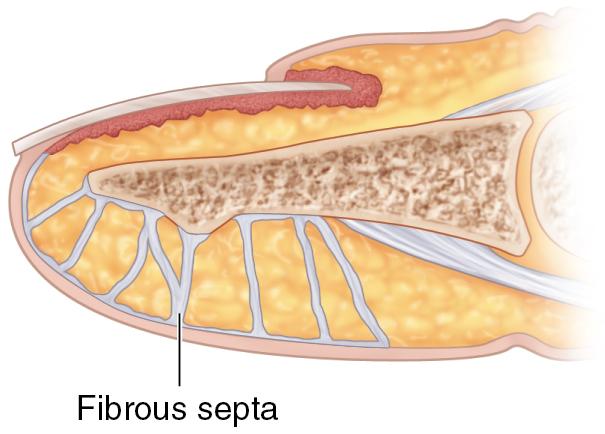 FIGURE 87.3, Fibrous septa must be divided to permit flap advancement.