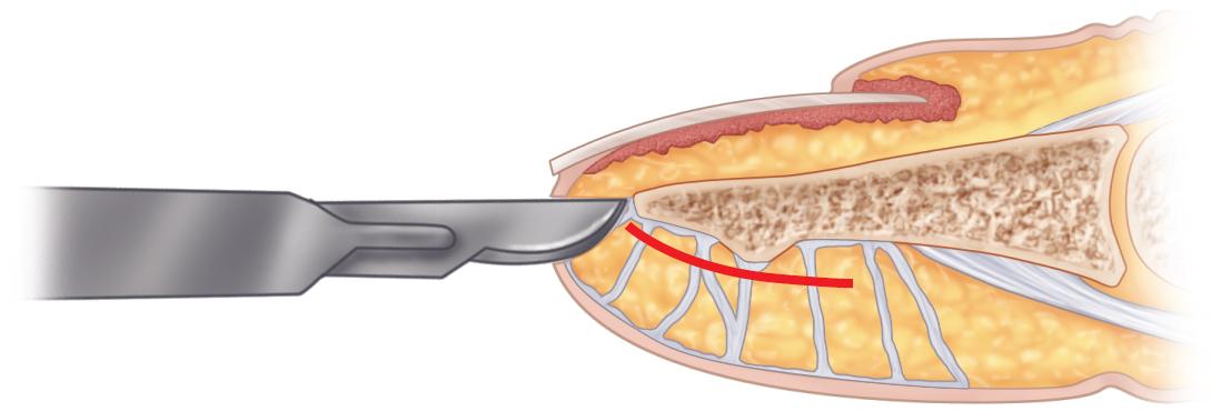 FIGURE 87.5, Flap is dissected off the periosteum.