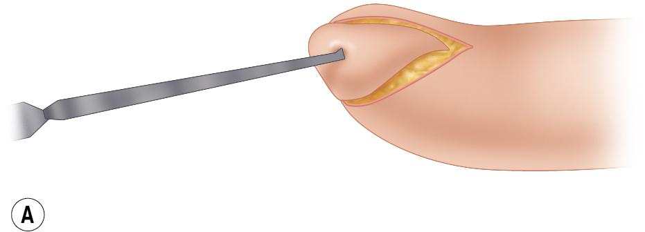 FIGURE 87.6, (A) Illustration of flap advancement. (B) Flap is advanced distally.