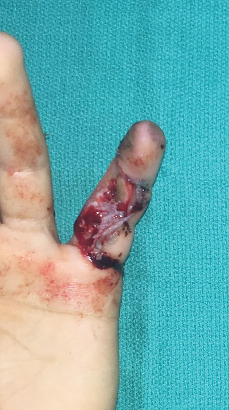 FIGURE 87.9, Volar soft tissue defect with exposed tendon.