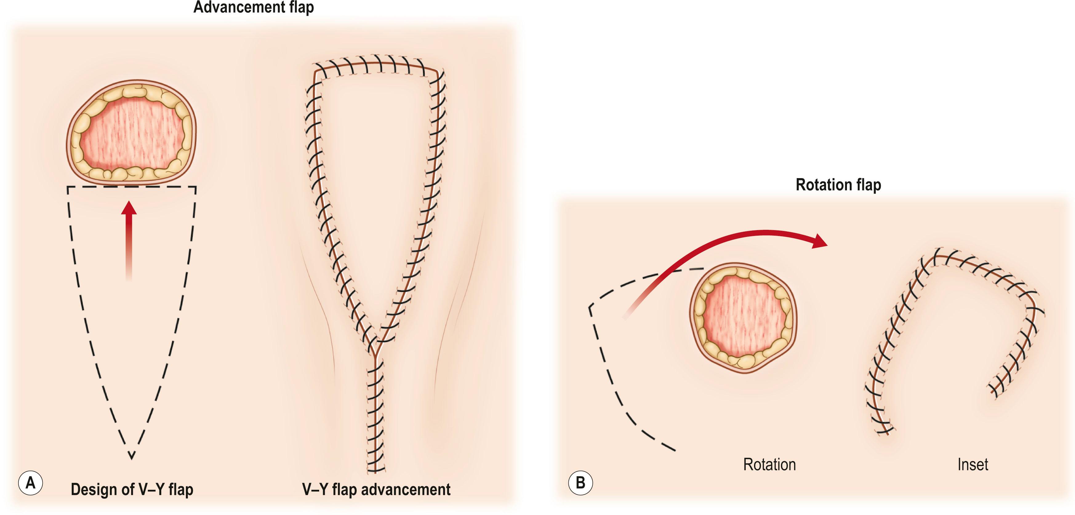 Figure 24.1, (A) Advancement flap. (B) Rotation flap.