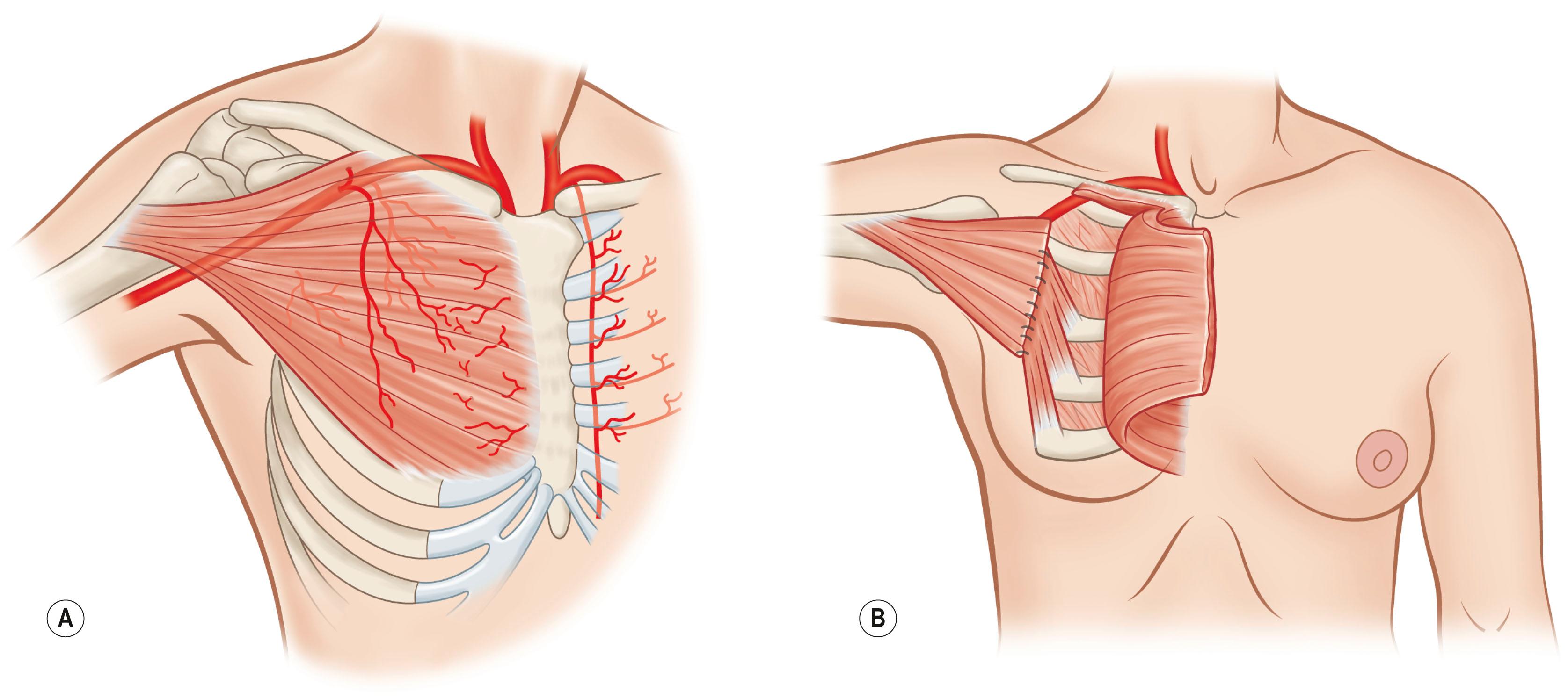 Figure 24.11, (A,B) Pectoralis major muscle flap segmental transposition.