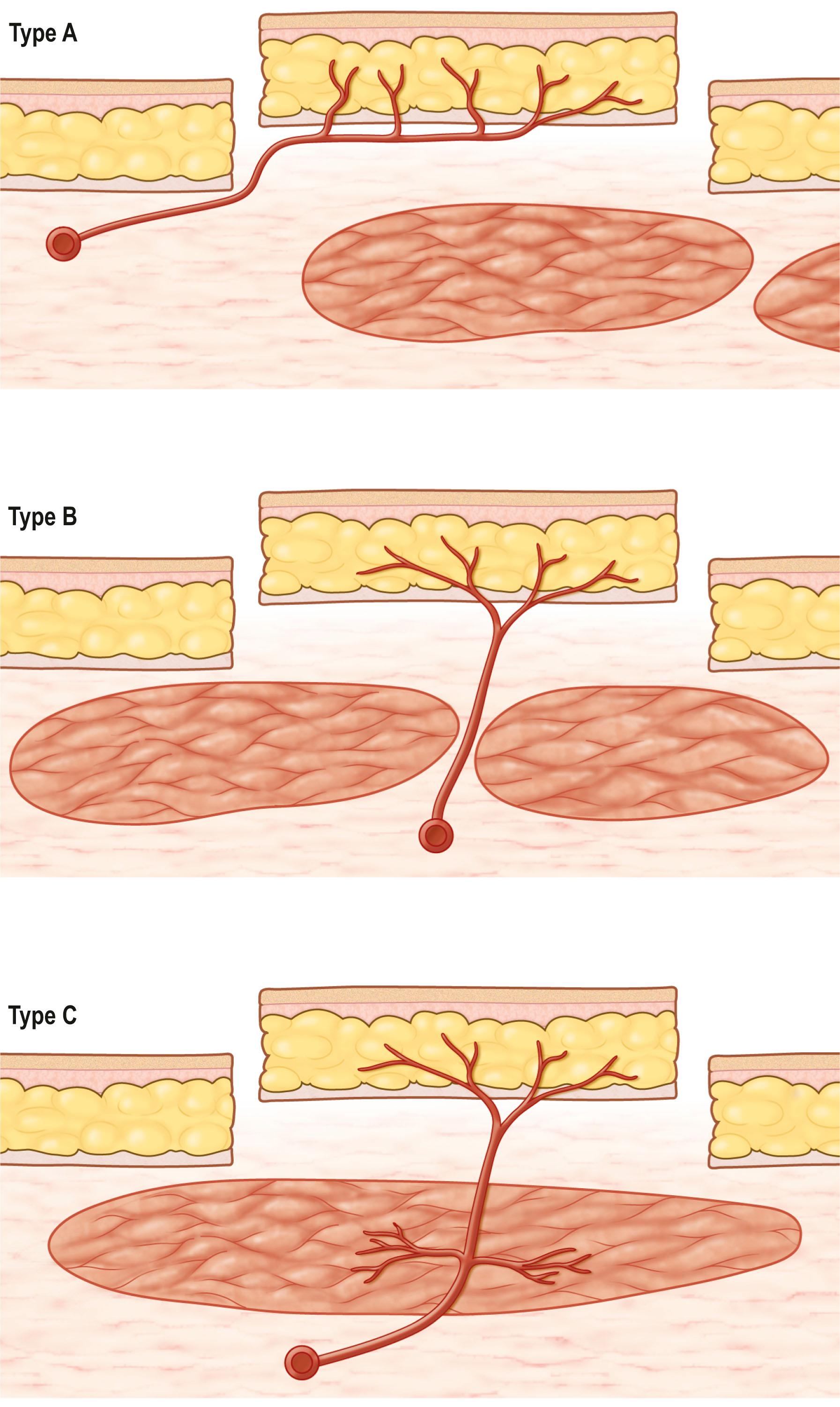 Figure 24.13, Mathes–Nahai classification of fascia/fasciocutaneous flaps.