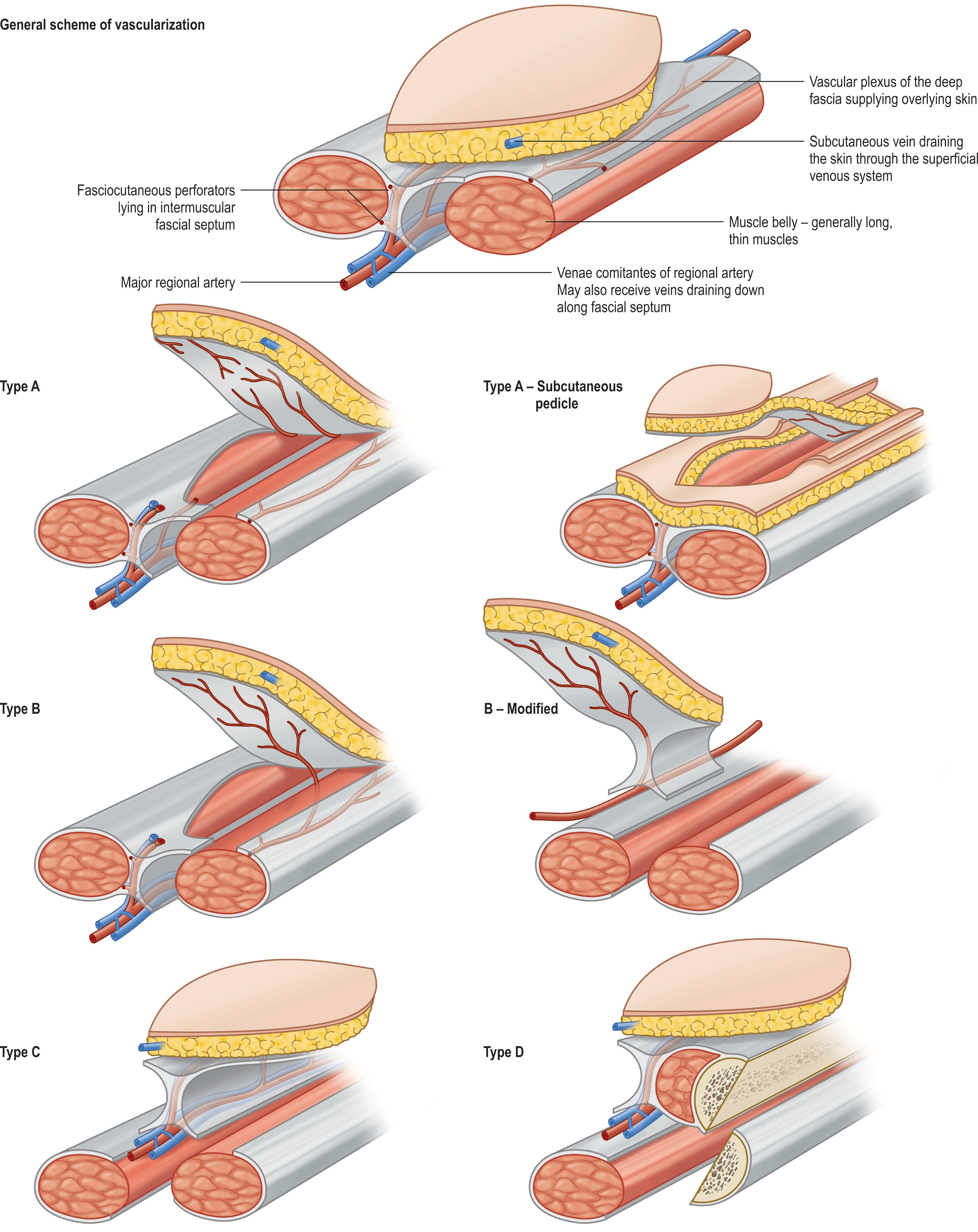 Figure 24.14, Classification of fasciocutaneous flaps.