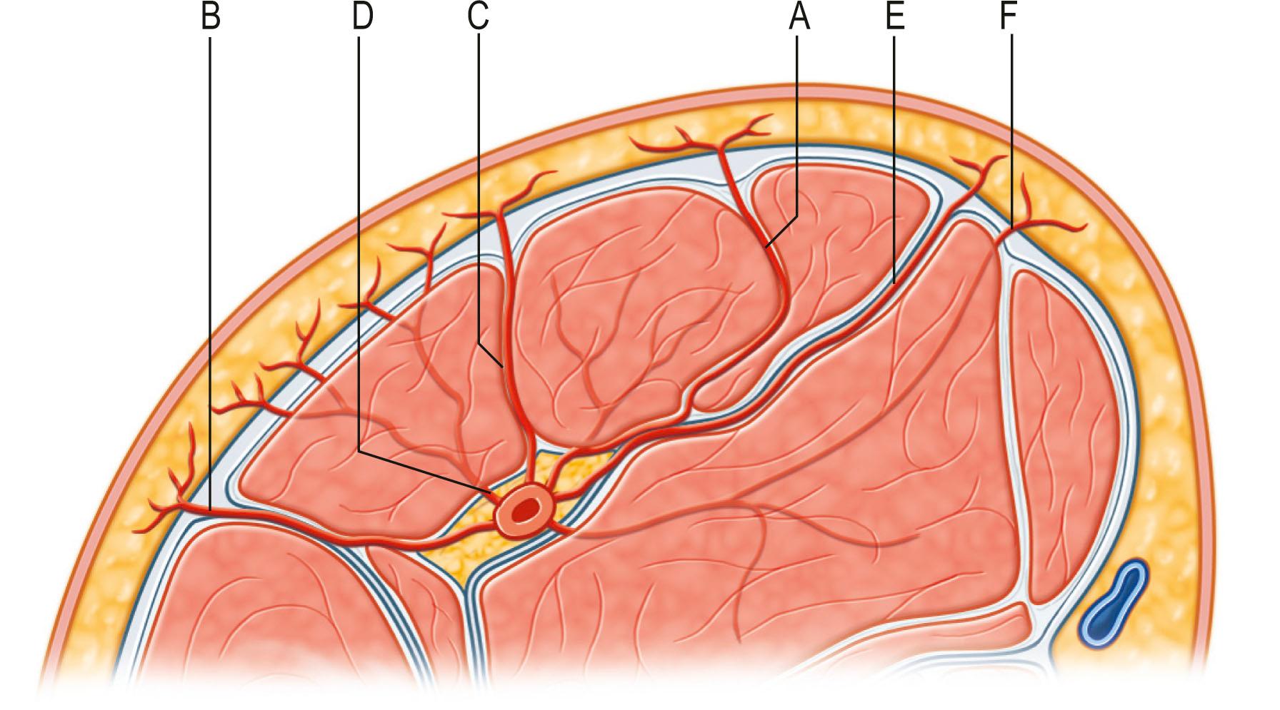 Figure 24.15, The six distinctive deep fascia perforators according to Nakajima and colleagues are indicated. A, direct cutaneous branch of a muscular vessel; B, septocutaneous perforator; C, direct cutaneous; D, musculocutaneous perforator; E, direct septocutaneous; F, perforating cutaneous branch of a muscular vessel. A separate type of fasciocutaneous flap could be named after each different perforator.