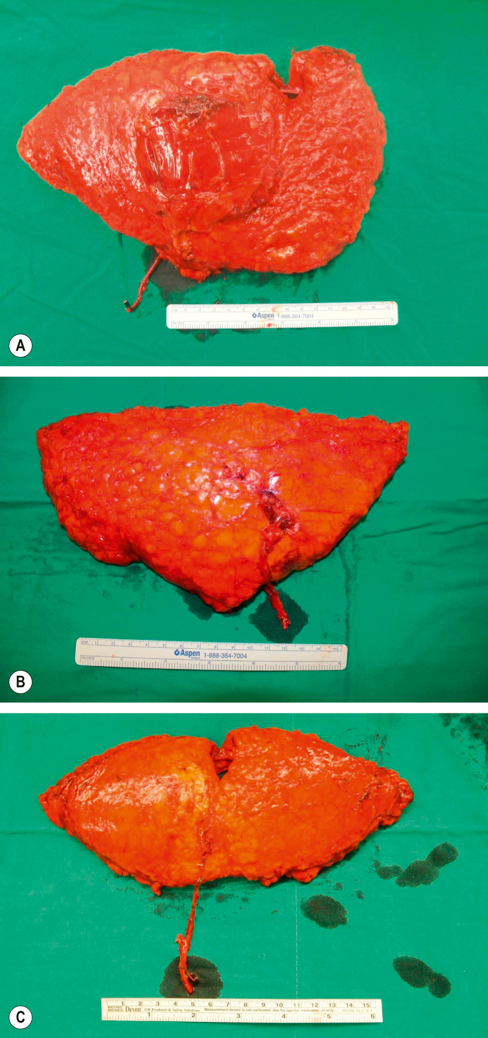 Figure 24.16, Evolution of the abdominal skin flap for breast reconstruction from transverse rectus abdominis muscle (TRAM) flap (A) to muscle-sparing TRAM (B) to deep inferior epigastic perforator (DIEP) flaps (C) .