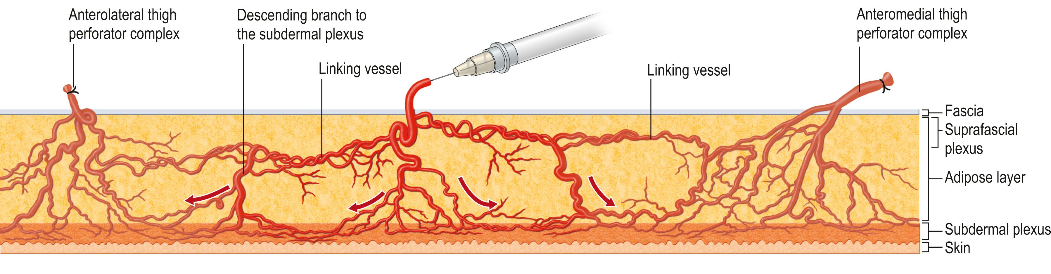 Figure 24.17, Each perforasome is linked with adjacent perforasomes by means of direct and indirect linking vessels. Direct linking vessels communicate directly with adjacent perforators and indirect linking vessels are communicating through the subdermal plexus.