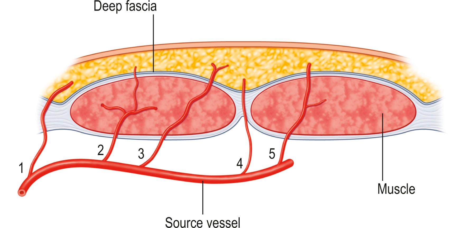 Figure 24.20, The different types of direct and indirect perforator vessels with regard to their surgical importance. 1, Direct perforators perforate the deep fascia only; 2, indirect muscle perforators predominantly supply the subcutaneous tissues; 3, indirect muscle perforators predominantly supply the muscle but have secondary branches to the subcutaneous tissues; 4, indirect perimysial perforators travel within the perimysium between muscle fibers before piercing the deep fascia; 5, indirect septal perforators travel through the intermuscular septum before piercing the deep fascia.