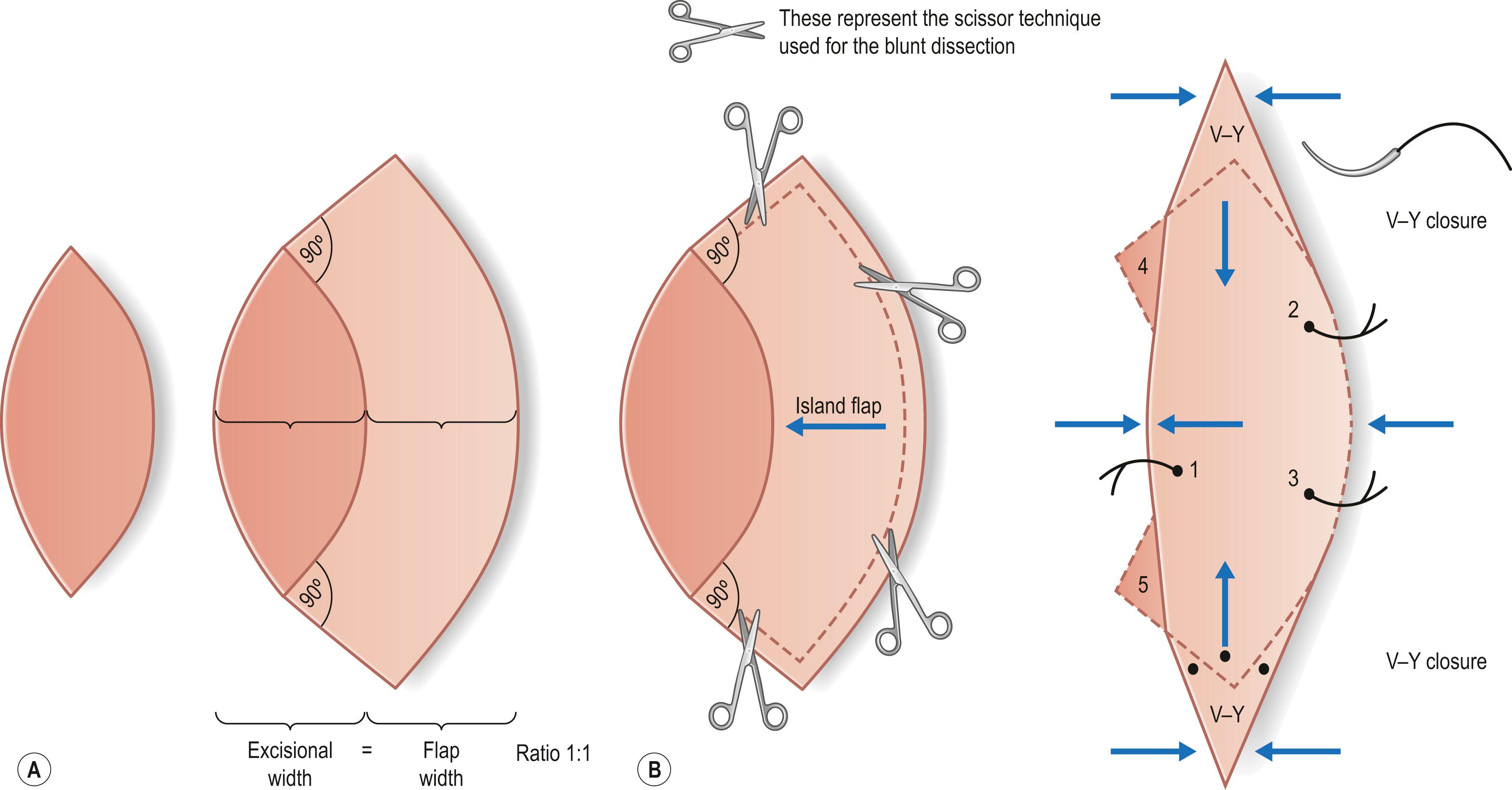 Figure 24.2, Keystone flap. (A,B) A keystone flap is a curvilinear-shaped trapezoidal-design flap essentially being two V–Y advancement flaps along the long axis of the flap.