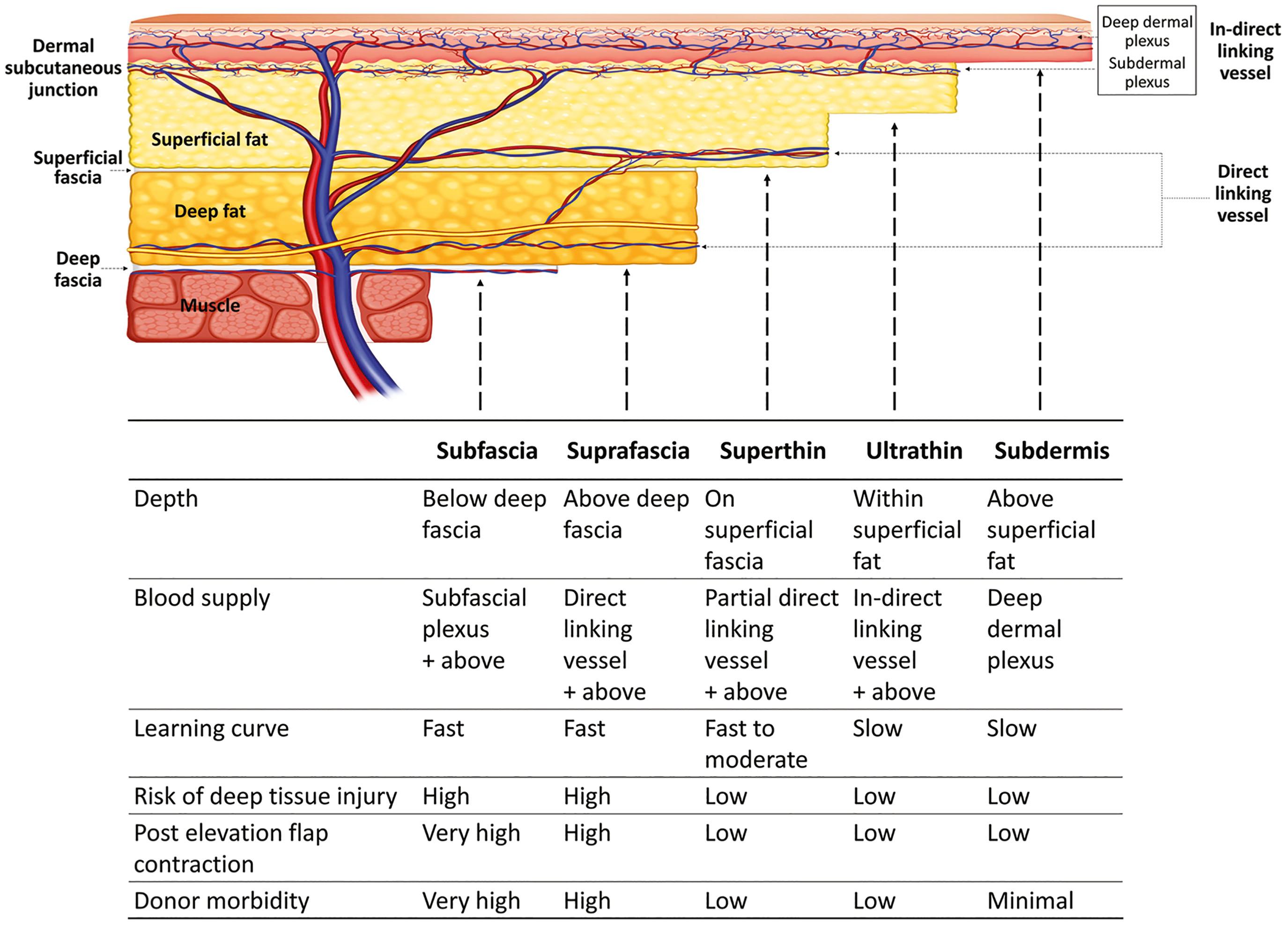 Figure 24.21, Layer of subcutaneous fat layer. Subcutaneous fat is divided into superficial fat layer with small fat lobule and deep fat layer with large fat lobule by superficial fascia. Note the fascia-like pseudofascia within the superficial fat. Based on the anatomical layers, five elevation planes are shown. The perforator flap can be elevated in subfascial, suprafascia, superthin, ultrathin, and subdermal (PSP, pure skin perforator) planes.