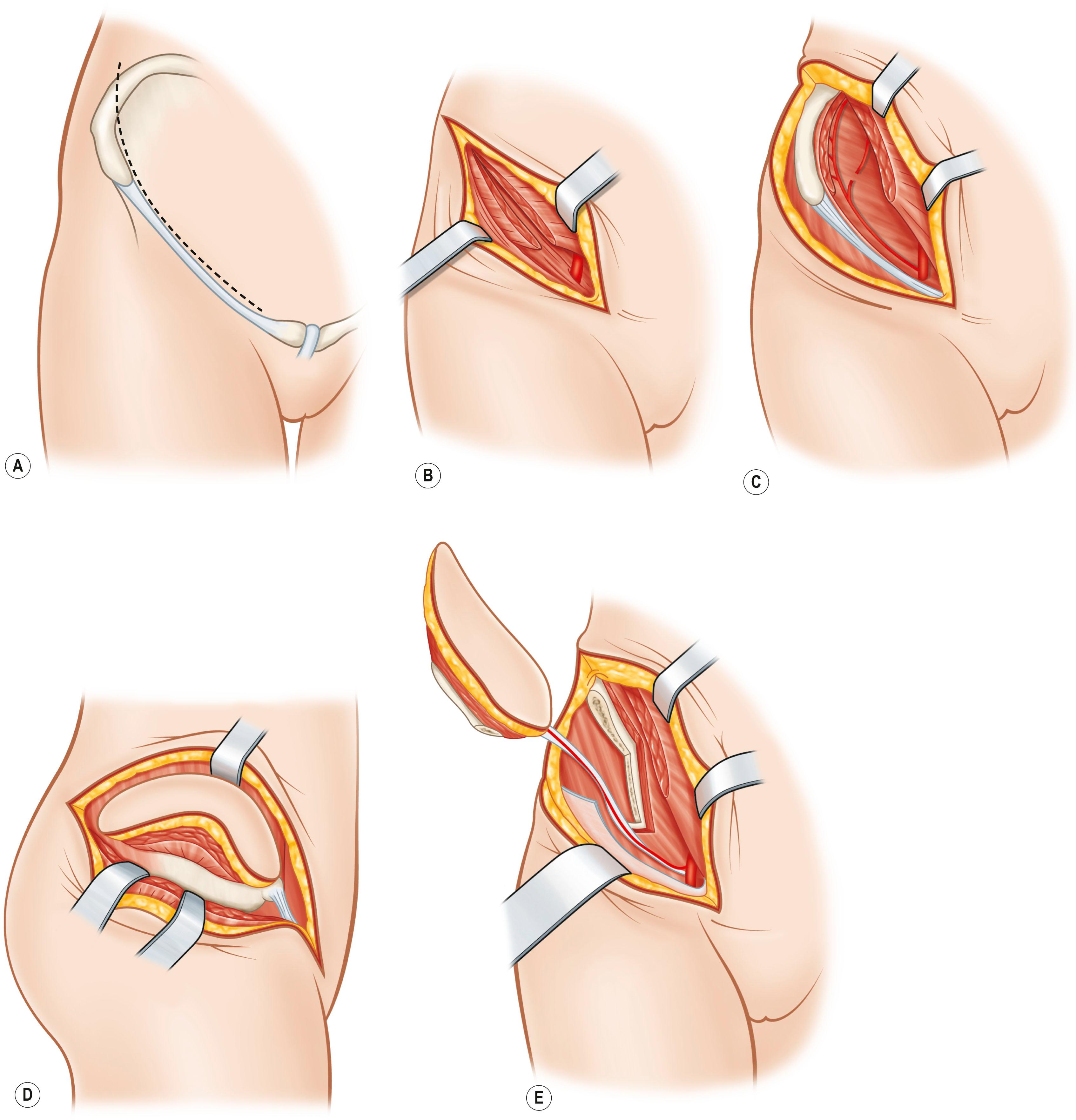 Figure 24.24, Deep circumflex iliac artery composite flap. (A) Marking. (B) Division of the external oblique aponeurosis and pedicle identification. (C) Division of the internal oblique. (D) Release of TFL. (E) Completion of dissection.