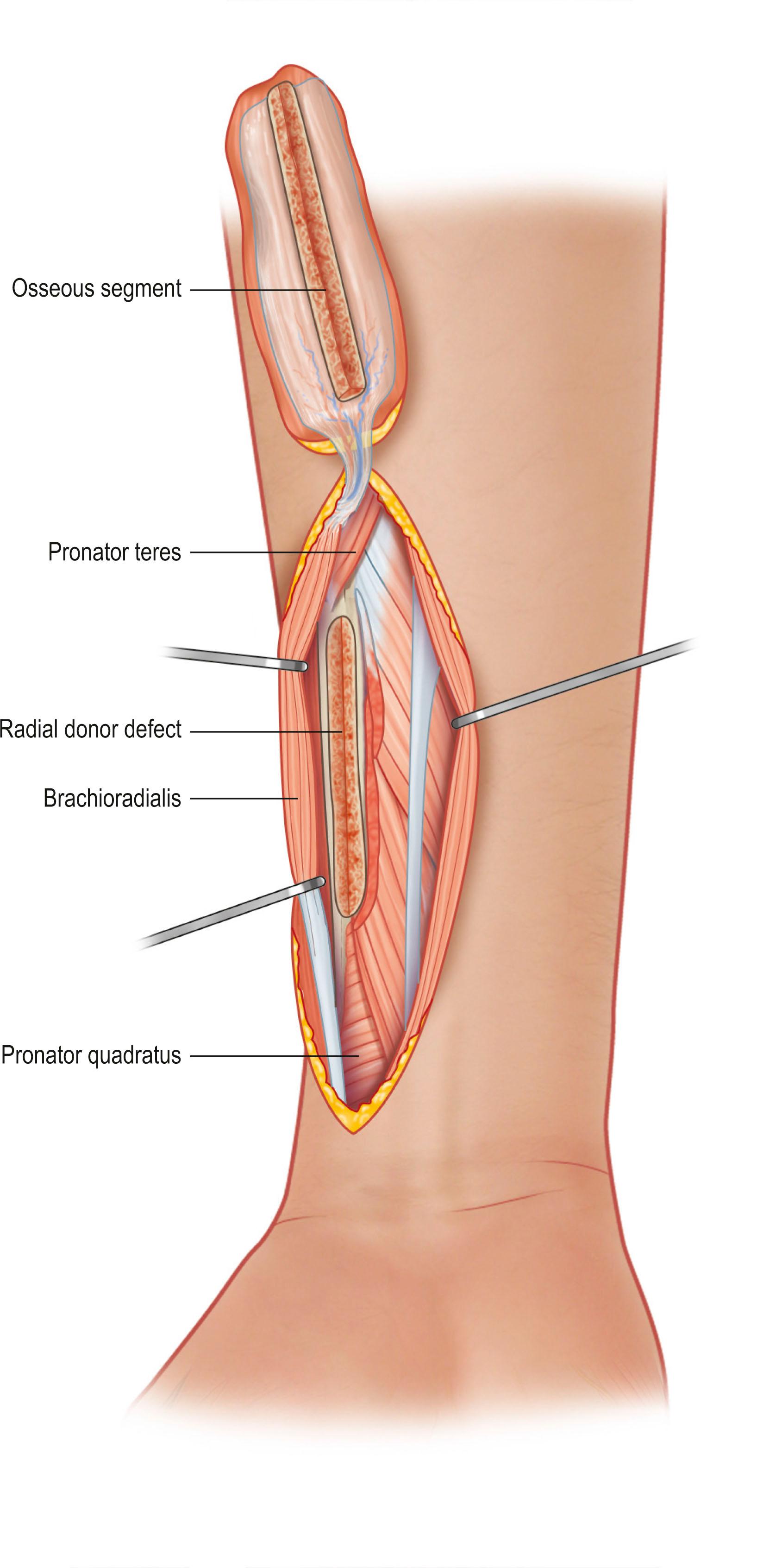 Figure 24.26, An osteocutaneous flap with composition of radius bone, and attached fasciocutaneous flap is elevated based on the proximal radial artery and vein pedicle.