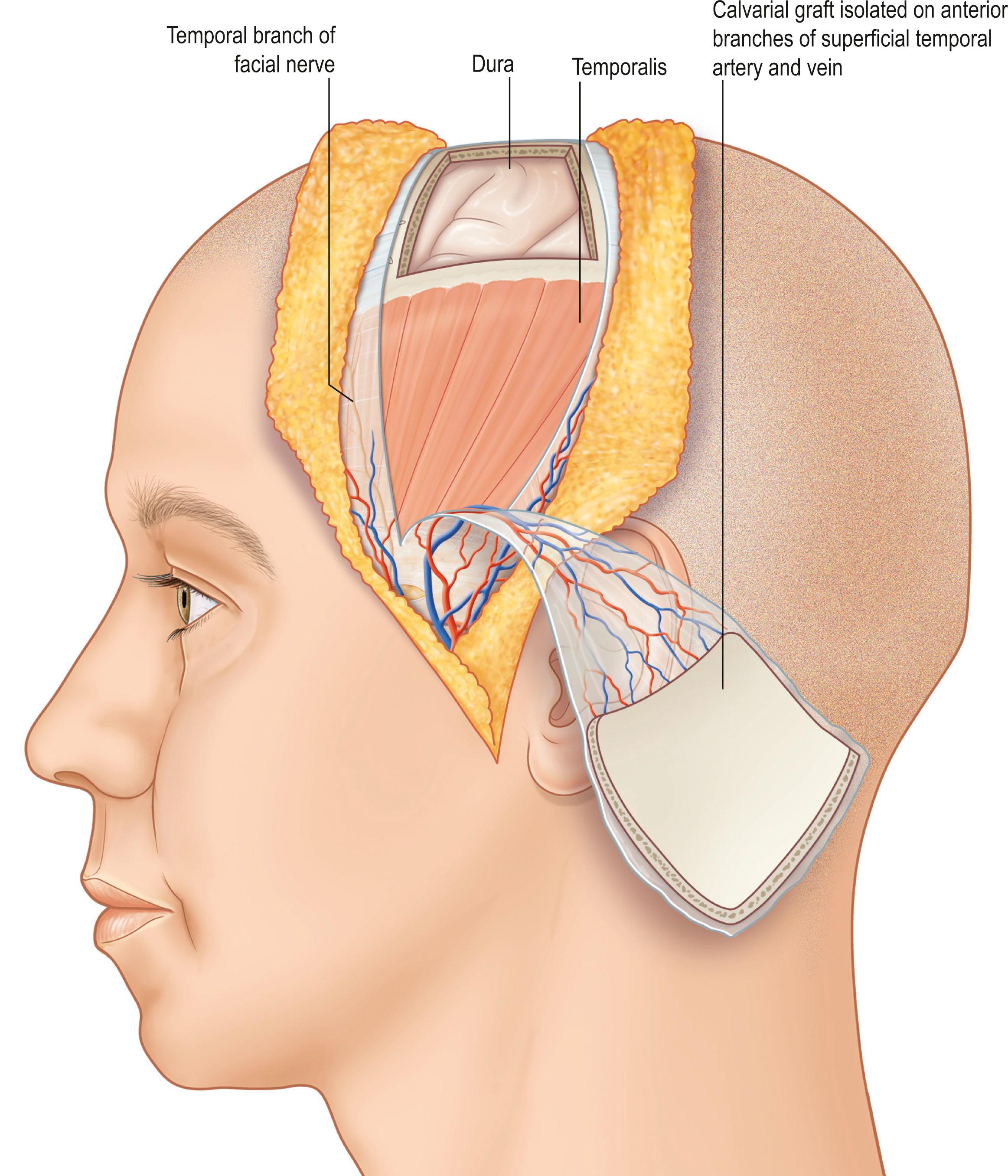 Figure 24.27, The calvarial osseous flap based on the superficial temporal artery with a segment of temporal fascia and muscle is elevated.