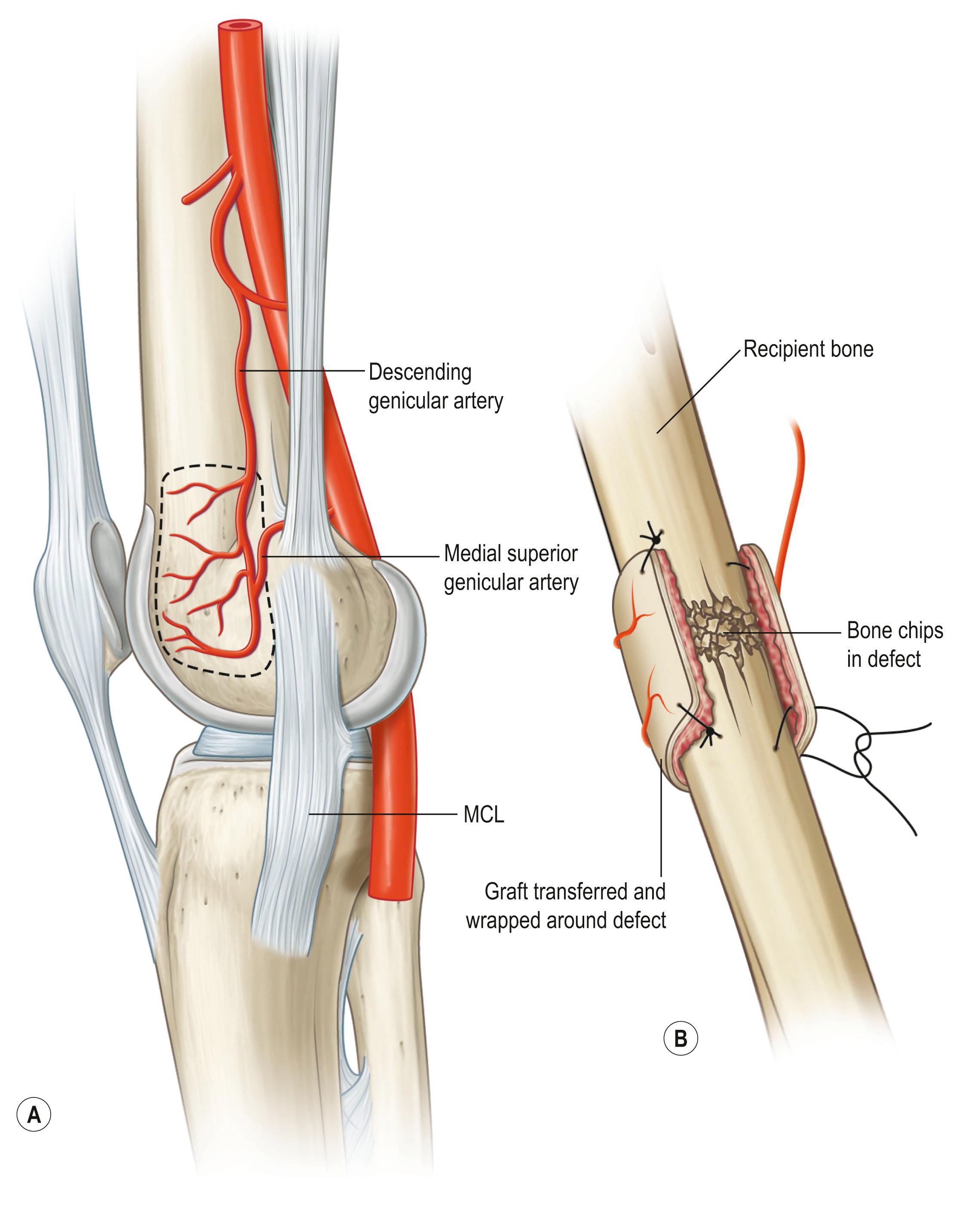 Figure 24.28, The genicular osseous–periosteal flap, also known as the medial femoral condyle flap, is based on the articular branch of the descending genicular artery and vein with periosteum and thin (0.5–1.0 mm) layer of outer cortical bone (A) . It is commonly used to reconstruct small bone defects, avascular necrosis of the bone and other complex defects of the hand (B) . MCL, Medial collateral ligament.