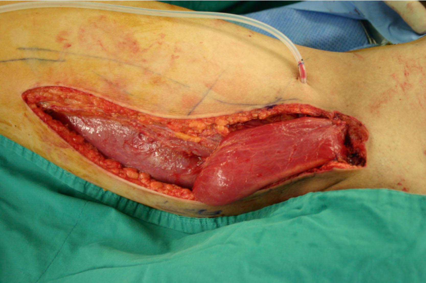 Figure 24.4, Example of a gracilis muscle flap. It can be named a medial circumflex femoral artery-based (circulation) gracilis muscle (constituents) free (contiguity) flap with antegrade flow (construction) with no conditioning (conditioning) and muscle only (conformation) according to the complete classification.