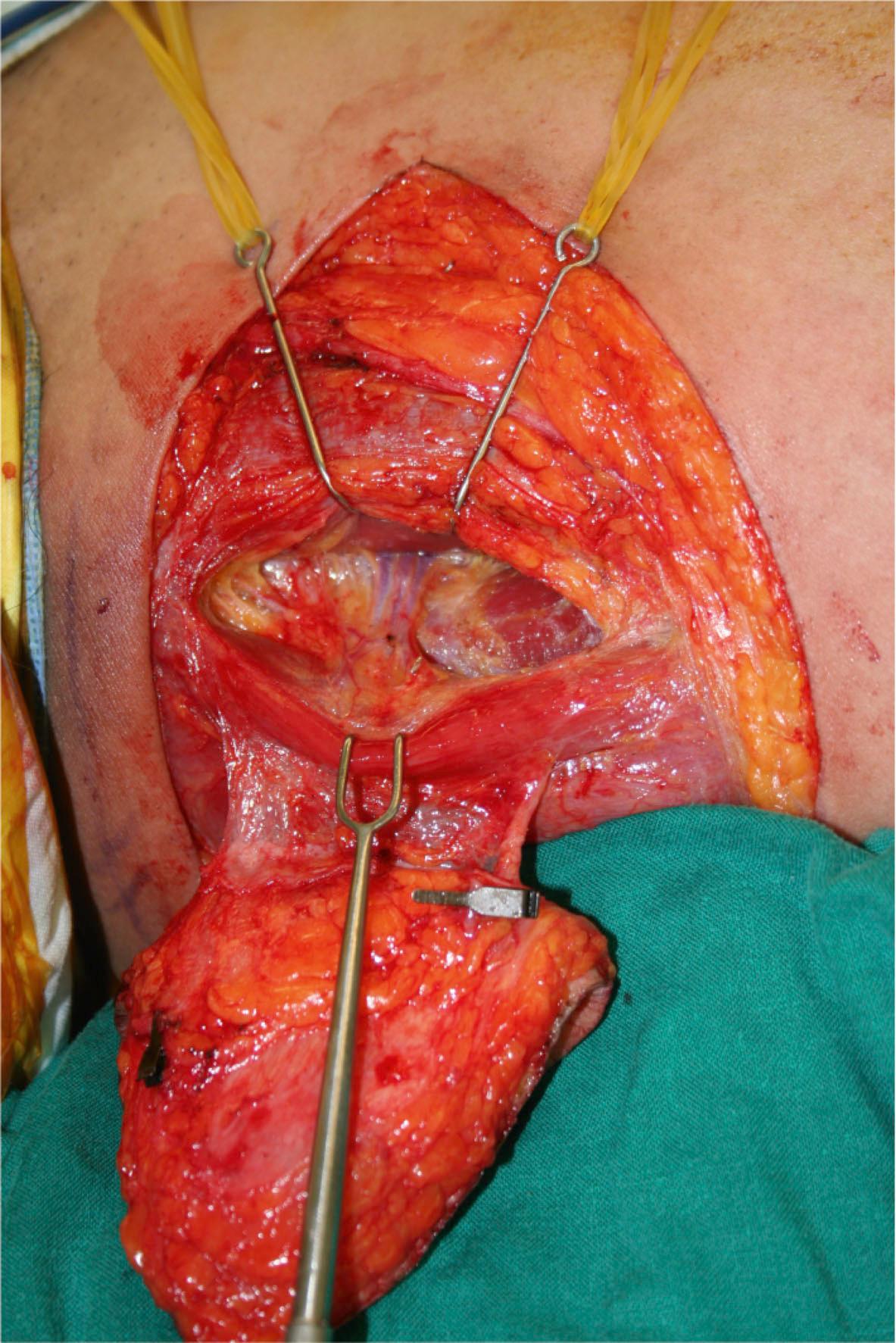 Figure 24.5, Example of a musculo-fascio-cutaneous flap including the gracilis muscle and the combined skin and fascia.