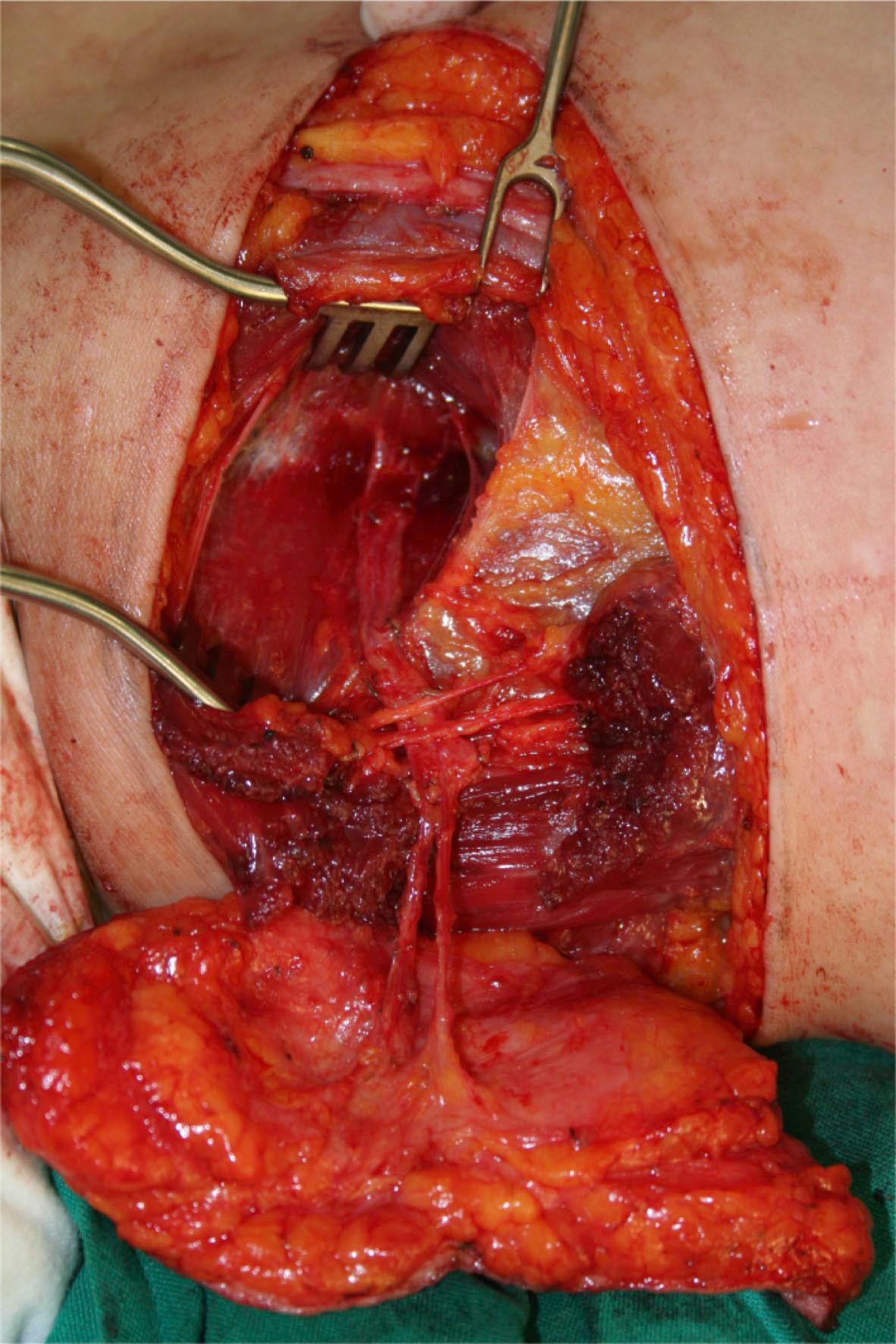 Figure 24.6, Example of flap from the upper medial thigh, supplied only with a perforator without the gracilis muscle and the fascia.