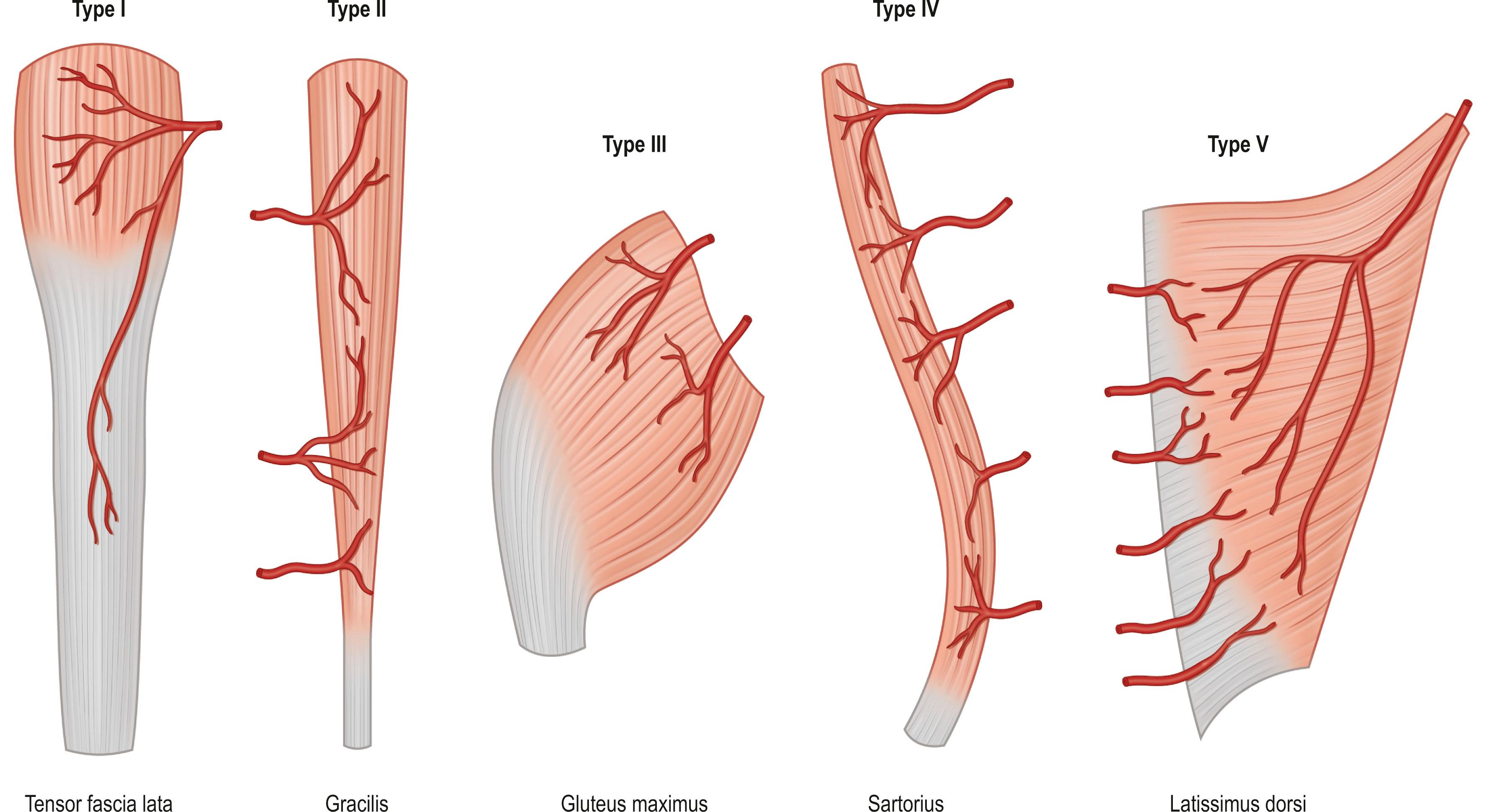 Figure 24.7, Mathes–Nahai classification of muscle and musculocutaneous flaps.