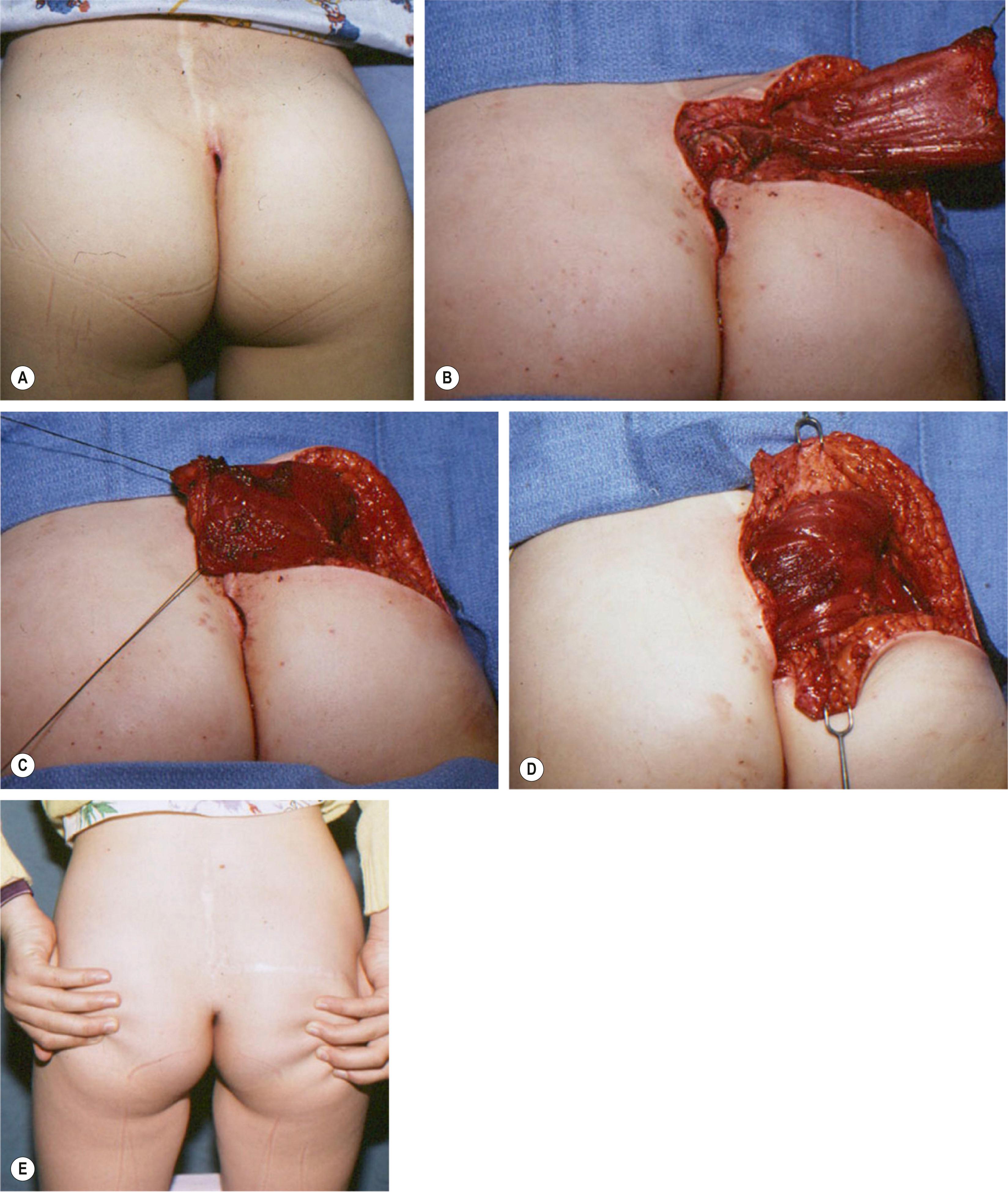 Figure 24.10, (A–E) Function-preserving muscle flap design.