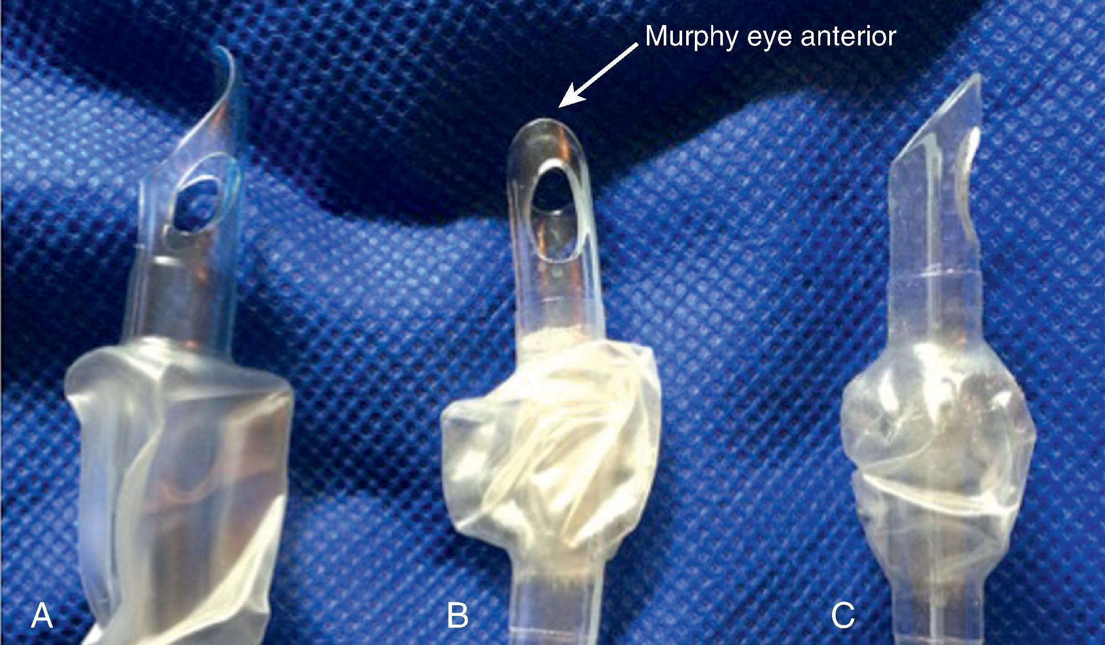 Fig. 24.12, (A) Centrally directed endotracheal tube with a Parker Flex-Tip. (B) Rotation 90 degrees counterclockwise. (C) Common rigid laryngoscope intubating direction.