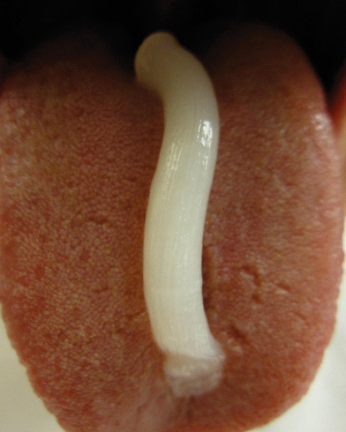 Fig. 24.18, Intraoral anesthesia: the 5% lidocaine toothpaste method.