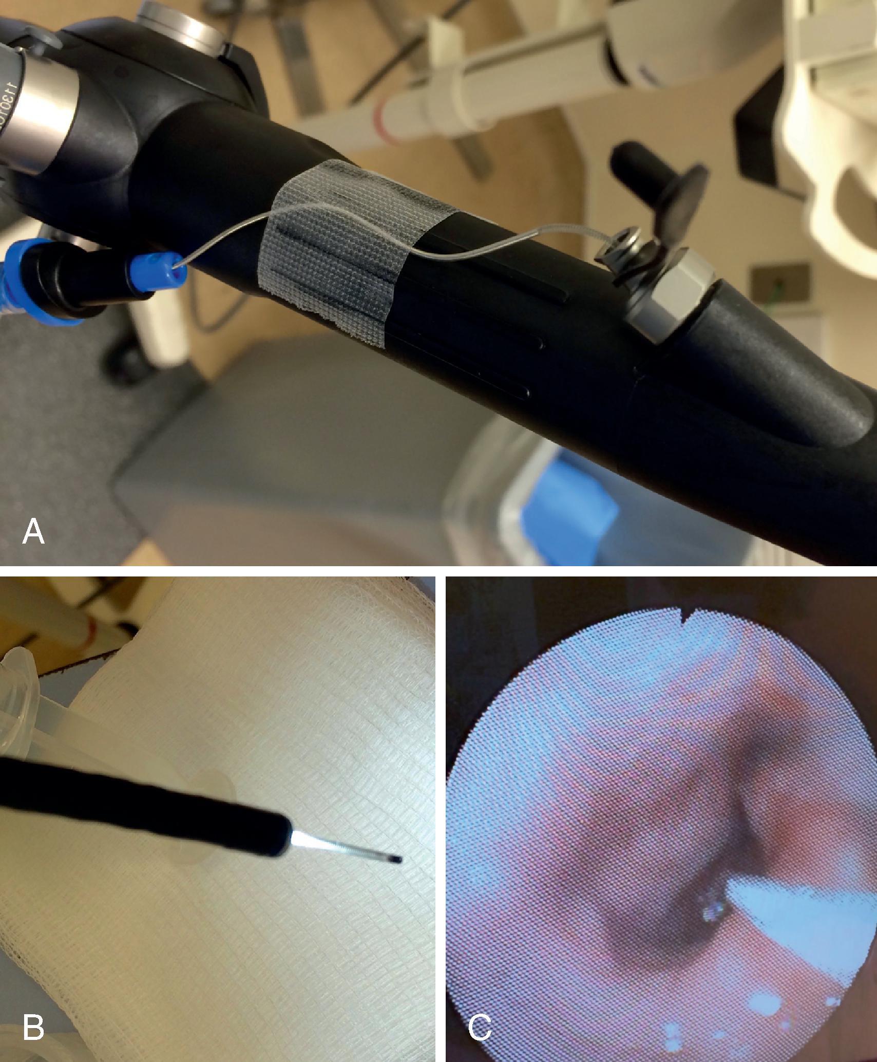 Fig. 24.19, (A) Proximal epidural catheter taped to the handle by working channel. (B) Distal catheter 1 cm out from the tip. (C) Drop of lidocaine from initial “spray as you go.”