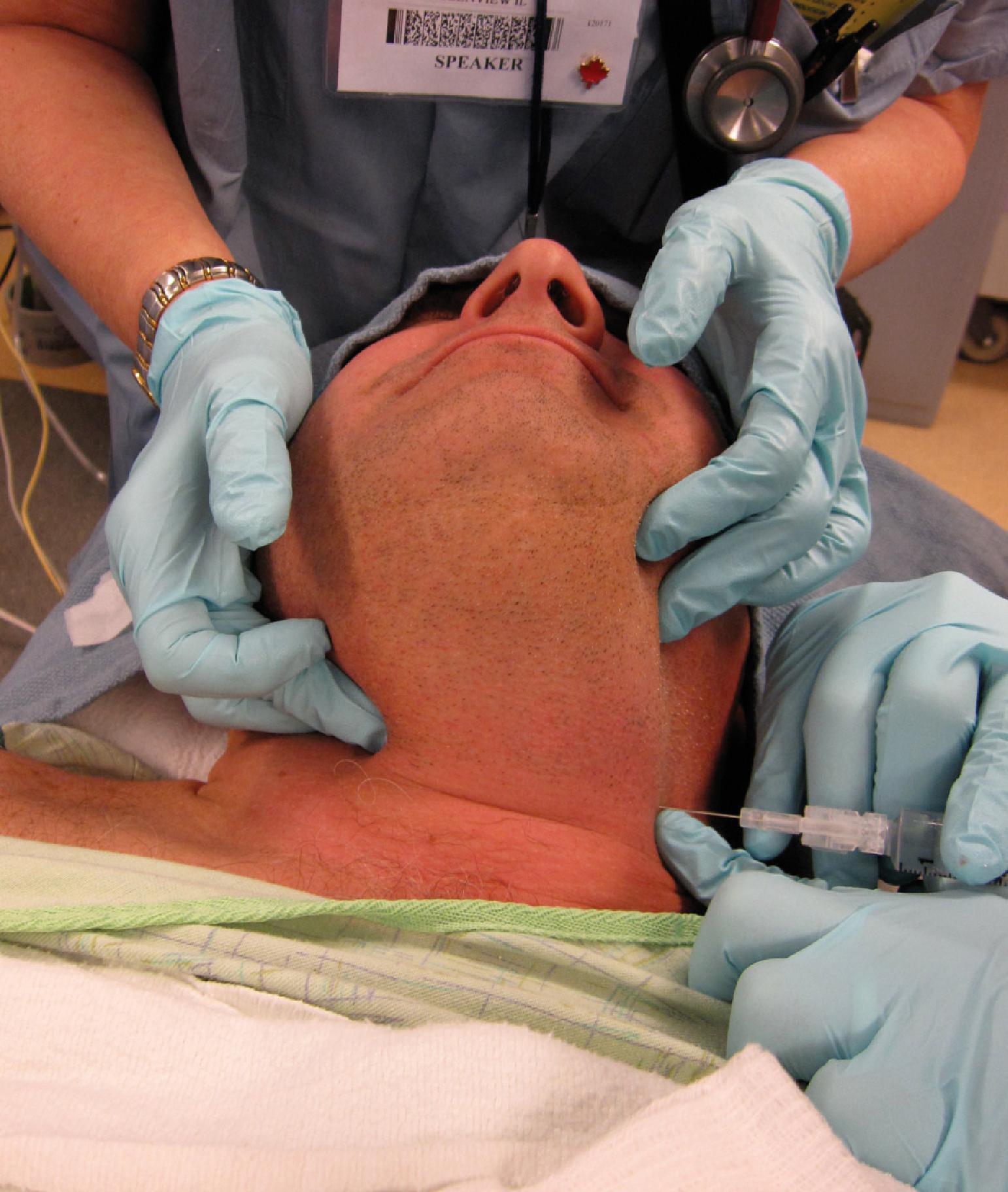 Fig. 24.20, Superior laryngeal nerve block. The assistant holds pressure on the right hyoid cornu while the operator directs the local anesthetic 22-gauge needle at the left hyoid cornu.