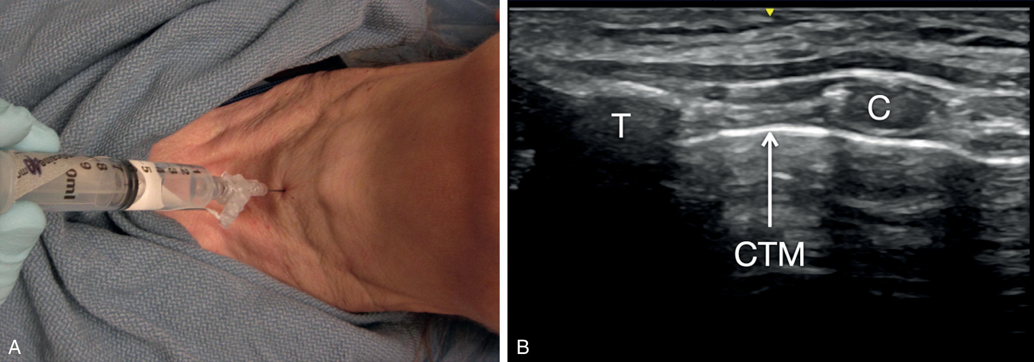 Fig. 24.21, (A) Transtracheal block. The operator braces his or her hand on the patient’s chest while aspirating for air through the cricothyroid membrane. (B) Sagittal plane ultrasound image of the cricothyroid membrane, where left is cranial and right is caudal. C, Cricoid cartilage; CTM, cricothyroid membrane; T, thyroid cartilage;.