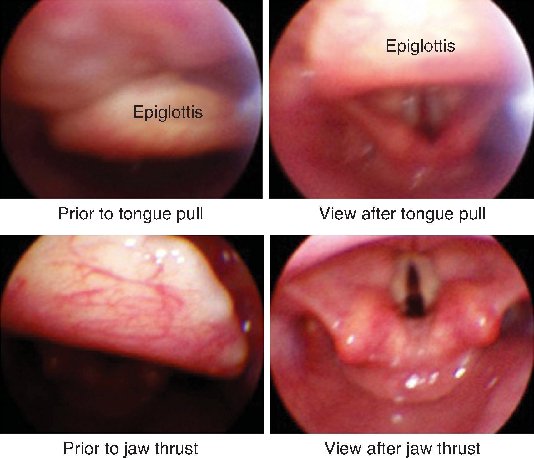 Fig. 24.25, Effects of tongue pull and jaw thrust on epiglottic and glottic views.