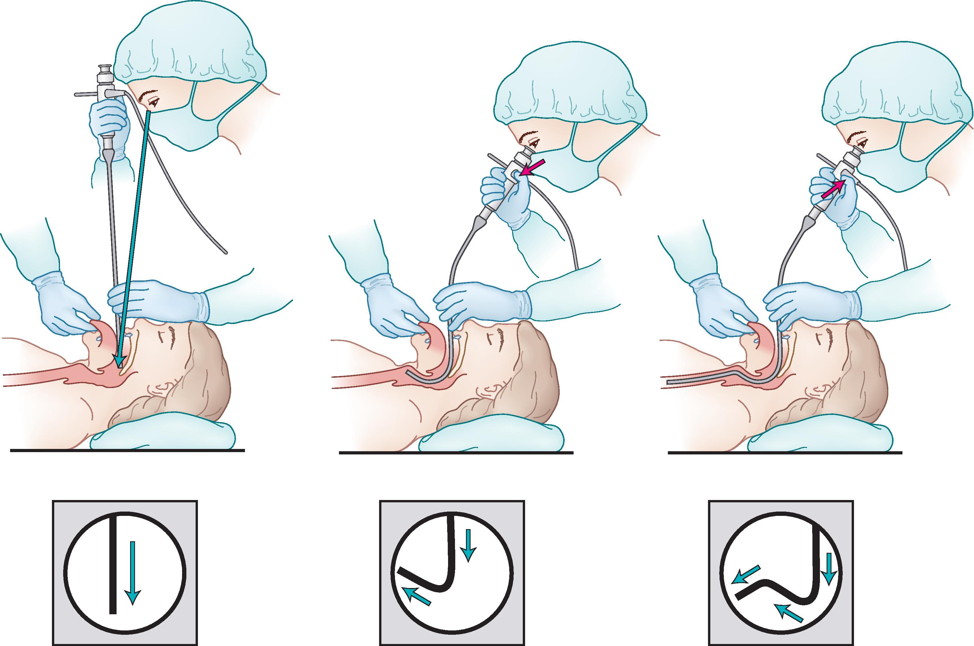 Fig. 24.27, Three directions in the anatomic approach to flexible scope intubation ( lefttoright ): downward into the pharynx, upward through the vocal cords, and downward into the trachea.