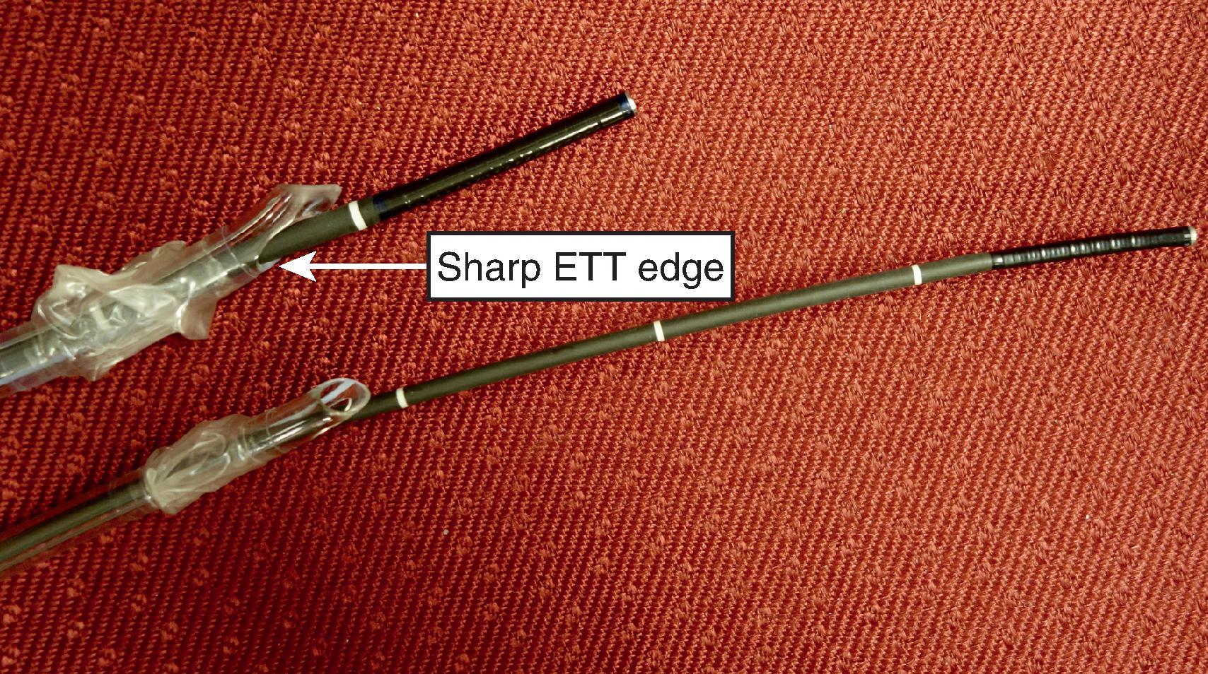 Fig. 24.29, Pediatric and adult flexible intubation scope (FIS) exiting endotracheal tube (ETT) through the Murphy eye. FIS withdrawal can result in a cut FIS sleeve by the ETT edge.