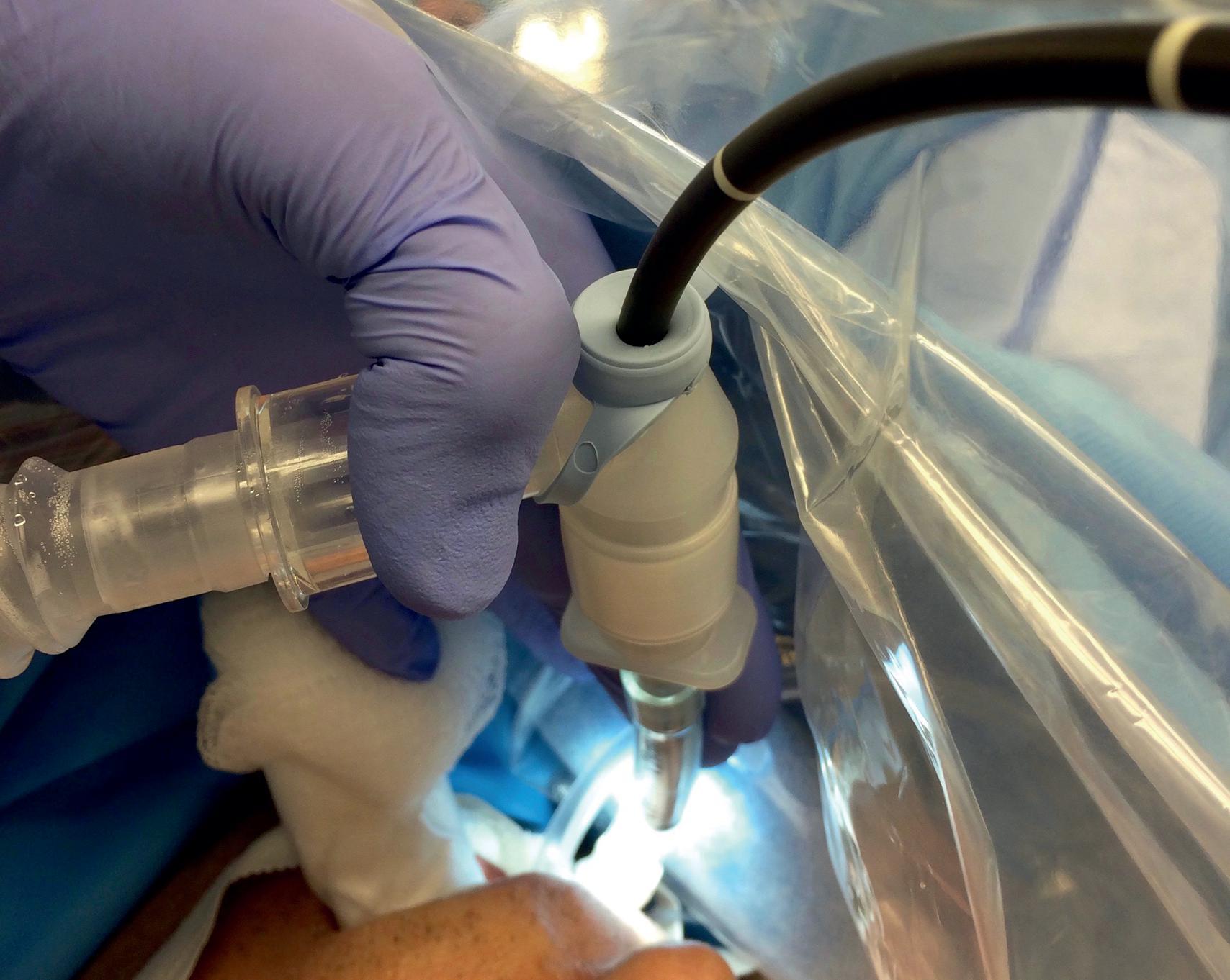 Fig. 24.9, Bronchoscopy swivel adapter with a snug flexible bronchoscope diaphragm, permitting ventilation with no leakage.