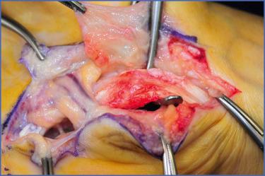 Fig. 10.11, Attrition of Ring and Little Finger FDP Tendons by Hook of Hamate