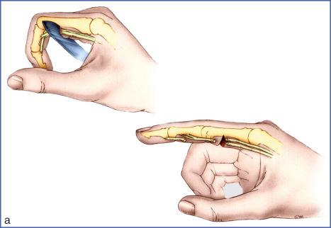 Fig. 10.7, (a) If the laceration occurs with the finger in flexion, the distal ends of the tendon will be pulled away from the wound once the finger is placed in extension. (b) If the laceration occurs with the finger in extension, recovery of the distal ends of the tendon is facilitated by flexion of the IP joints.