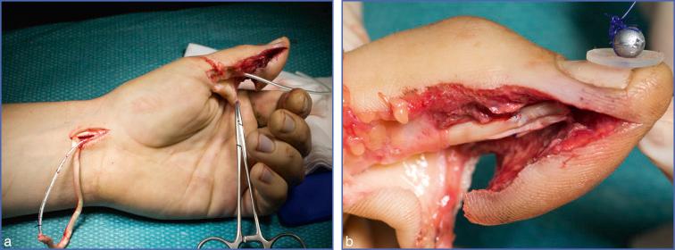 Fig. 10.10, Leddy-Packer Type 1 Injury to Thumb.