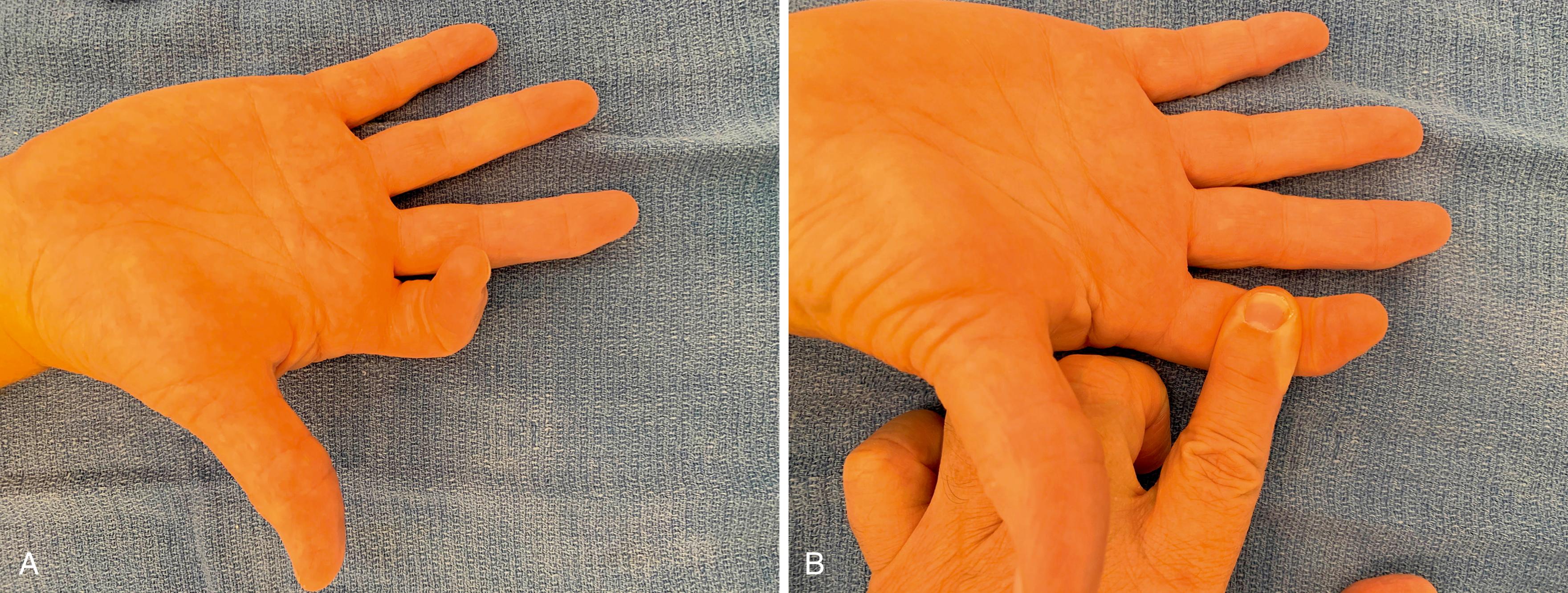 Fig. 6.1, A, Continuity of FDS tendon is evaluated by asking the patient to flex the finger actively while holding MCP joints of the uninvolved fingers in hyperextension and PIP and DIP joints of the uninvolved fingers in full extension. This effectively eliminates the profundus and allows the superficialis action to be evaluated. B, Middle phalanx is held firmly, and active flexion at DIP joint is carried out. This shows continuity of FDP tendon.