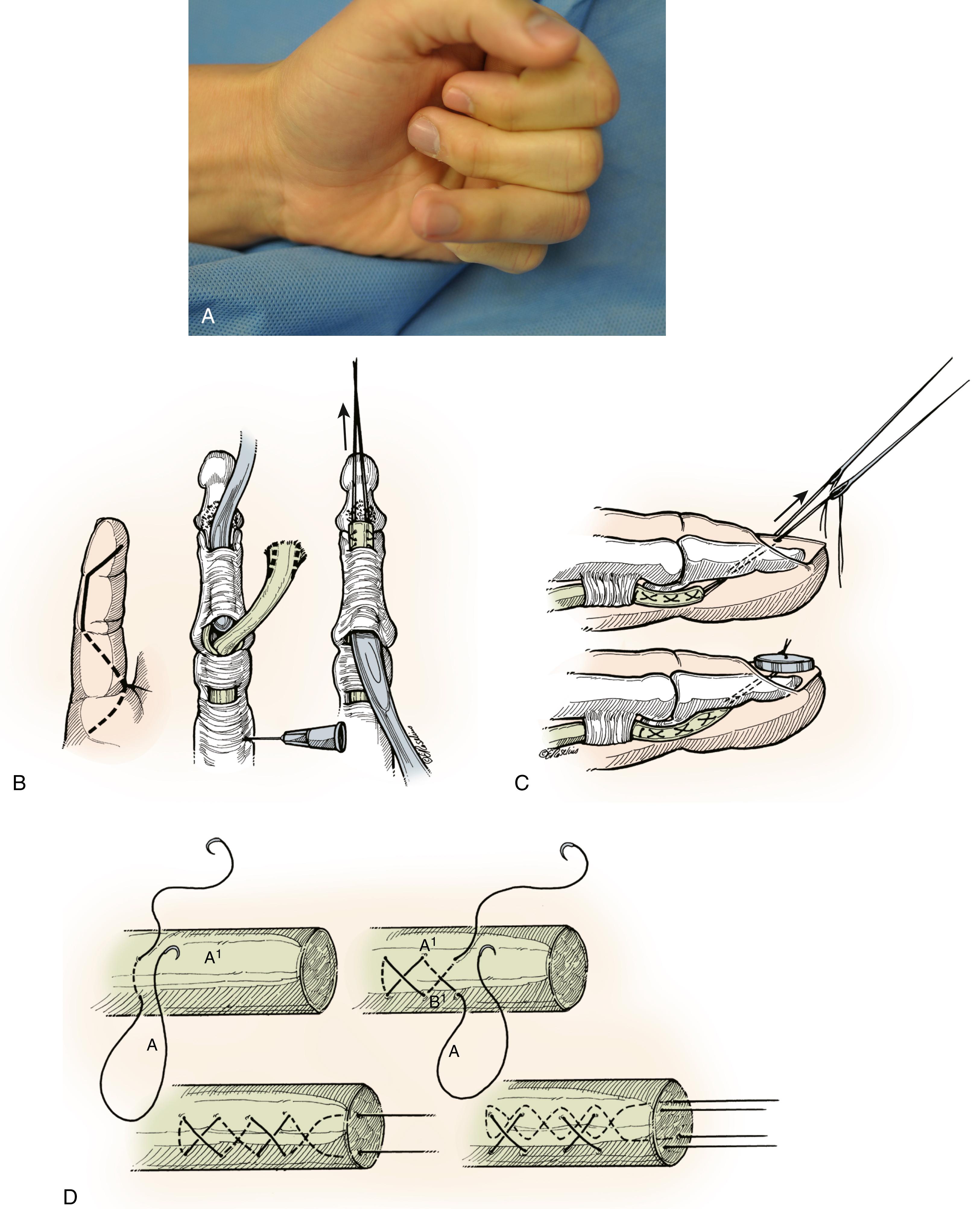 Fig. 6.12, Author’s preferred technique for FDP tendon reattachment to bone. A, Clinical photograph of a patient without active DIP joint flexion. B, Midlateral exposure over middle phalanx is preferred. This incision may be extended diagonally over the pulp of the finger distally and into a Bruner incision proximally. Sourmelis-McGrouther technique of proximal stump retrieval is preferred. The stump of the profundus tendon may be delivered under the A4 pulley after sequential dilation of the pulley with pediatric cervical sounds of increasing diameter. A modified Becker grasping stitch core suture is placed within the tendon stump. C, Straight Keith needles are drilled from the volar proximal base of the distal phalanx in a distal dorsal direction to exit the nail plate through the sterile matrix (distal to the lunula and eponychial fold). The individual grasping core sutures are delivered to the dorsum of the finger after placement of the needles through the holes in the button. The sutures are tied while holding the tendon directly to bone using forceps. D, Four-strand modified Becker repair of the FDS.