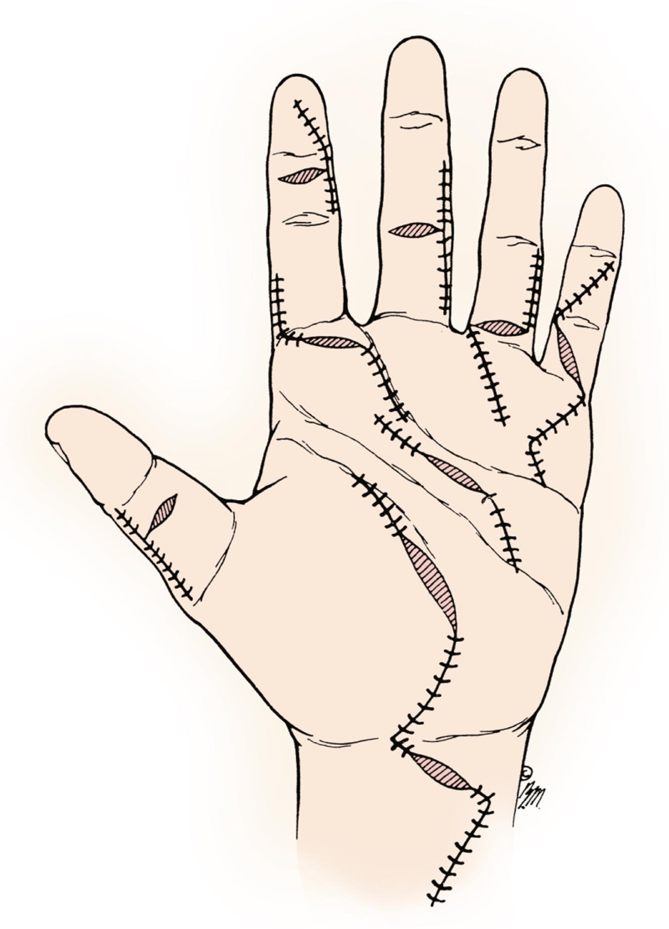 Fig. 6.14, Incision options for wound extension during flexor tendon repair.