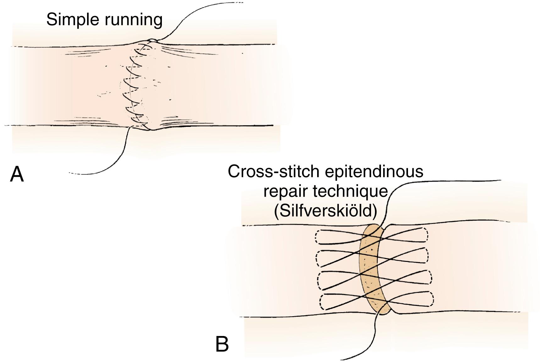 Fig. 6.15, Circumferential epitendinous suture techniques. A, The simple running suture is often placed in a “back wall first” technique to align the tendons prior to the core suture placement; 2 mm deep and 2 mm wide “throws” of the stitch are optimal. This method is also an excellent strategy to limit tension at the repair site and makes placement of the core suture easier. B, The Silfverskiöld cross stitch is stronger but more complex. It may also be used as a primary suture for the flat insertions of the FDS in lacerations near the PIP joint.