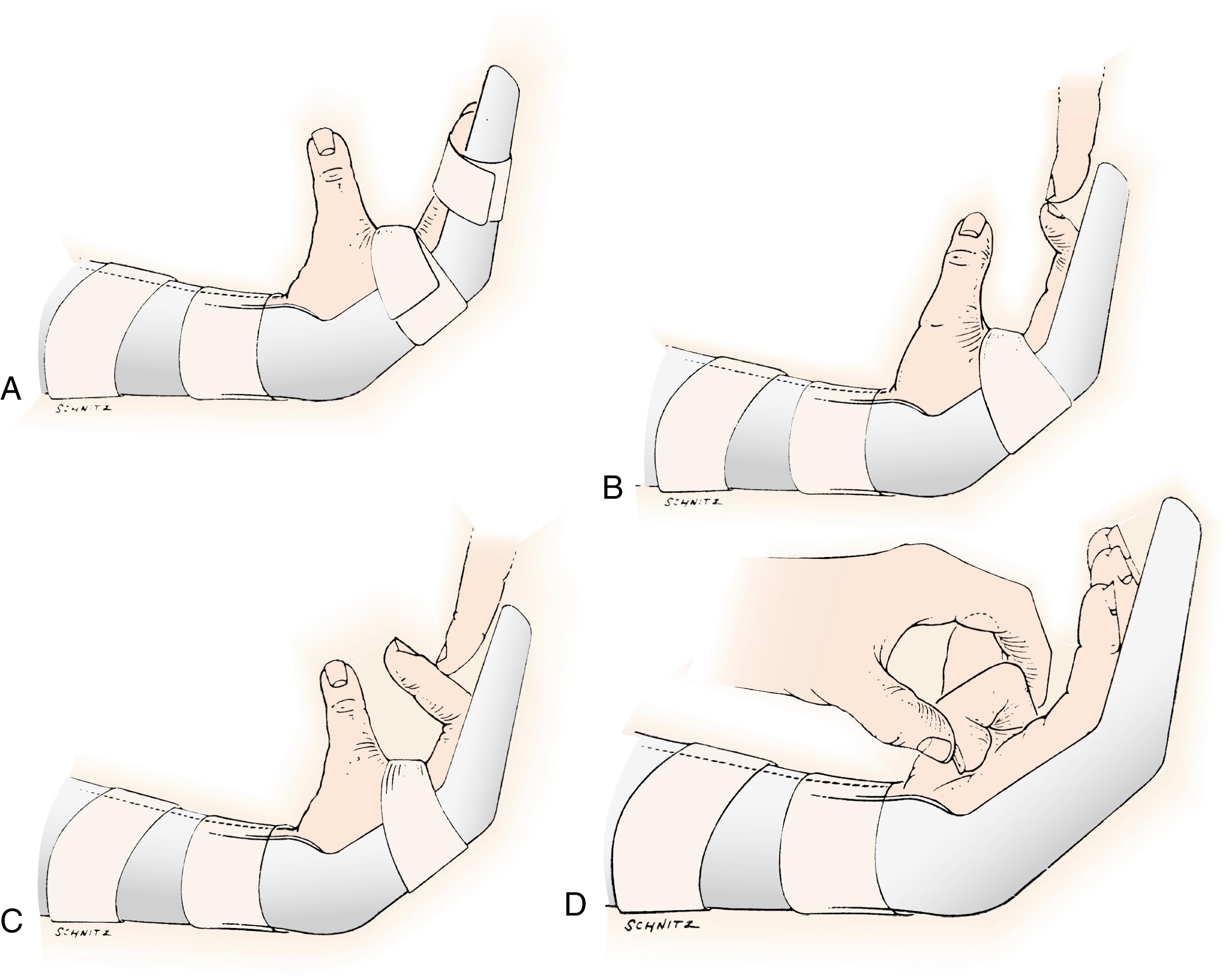 Fig. 6.16, Controlled passive motion method. A, Orthoplast dorsal blocking splint is used to hold wrist in mild flexion, MCP joints in about 45 degrees of flexion, and PIP and DIP joints in nearly full extension. B, Full isolated passive flexion of DIP joint. C, Full isolated passive flexion of PIP joint. D, Full passive flexion of MCP, PIP, and DIP joints.
