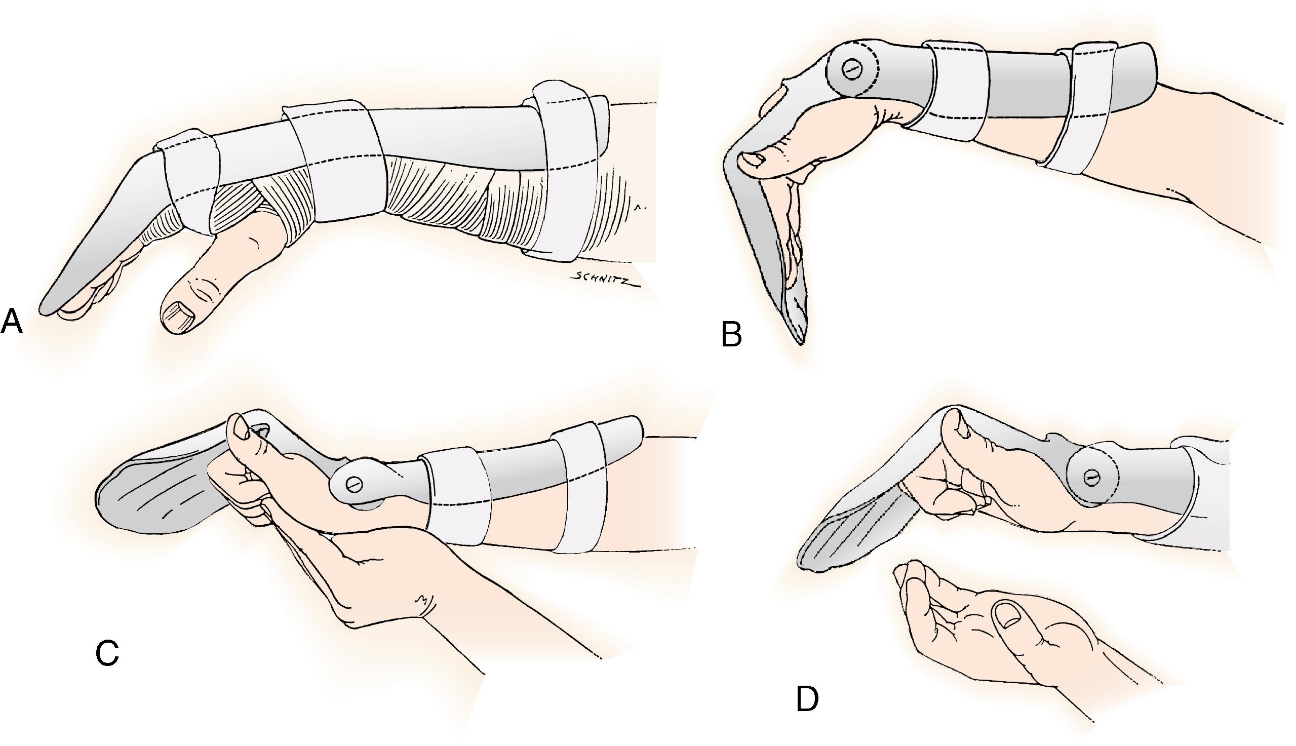 Fig. 6.17, Controlled place-and-hold motion after flexor tendon repair protocol. A, After removal of the surgical bandage, a traditional dorsal blocking splint that positions the wrist in 20 degrees of palmar flexion, MCP joints in 50 degrees of flexion, and IP joints in extension is applied. B, A splint is fabricated for static wrist positioning and maintenance of MCP joint flexion of at least 60 degrees. C, After composite passive digital flexion, the wrist is extended and passive flexion is maintained. D, The patient actively maintains digital flexion and holds that position for about 5 seconds. Patients are instructed to use the lightest muscle power necessary to maintain digital flexion.