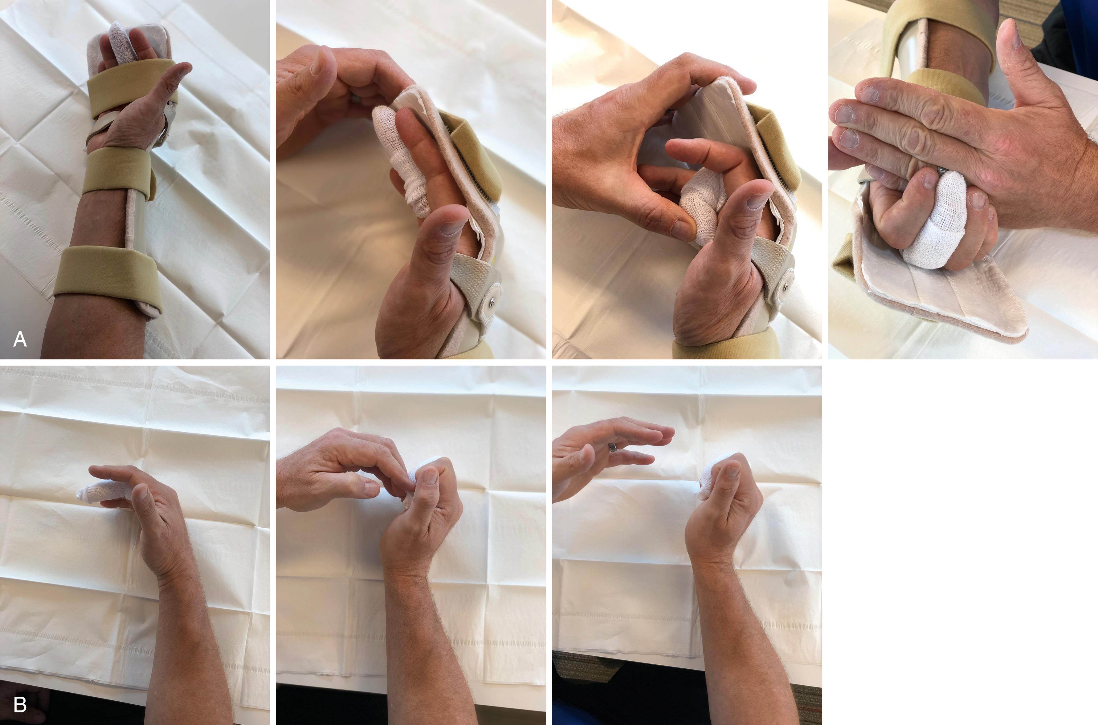 Fig. 6.18, Clinical examples of the author’s program following multistrand multigrasp flexor tendon repair for patients that can participate actively in a rehabilitation program. For these patients, the authors favor use of a static splint for hand protection and a program of early active assistive exercises to improve tendon excursion in the early postoperative period. A, A resting splint with neutral wrist and MCP joints flexed and IP joints comfortably extended allows early active range-of-motion exercises. In this position, early place range-of-motion exercises can be initiated and place-and-hold exercises completed. B, During supervised occupational therapy, the finger is passively flexed with the wrist in neutral. Wrist is extended while maintaining passive digital flexion. The patient holds this position with light active flexion to generate tendon excursion.