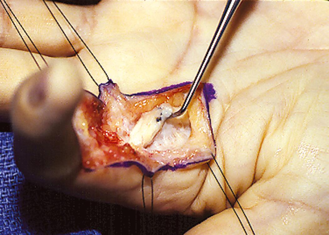 Fig. 6.20, Localized area of tendon adhesion permits simple tenolysis to restore full tendon gliding.