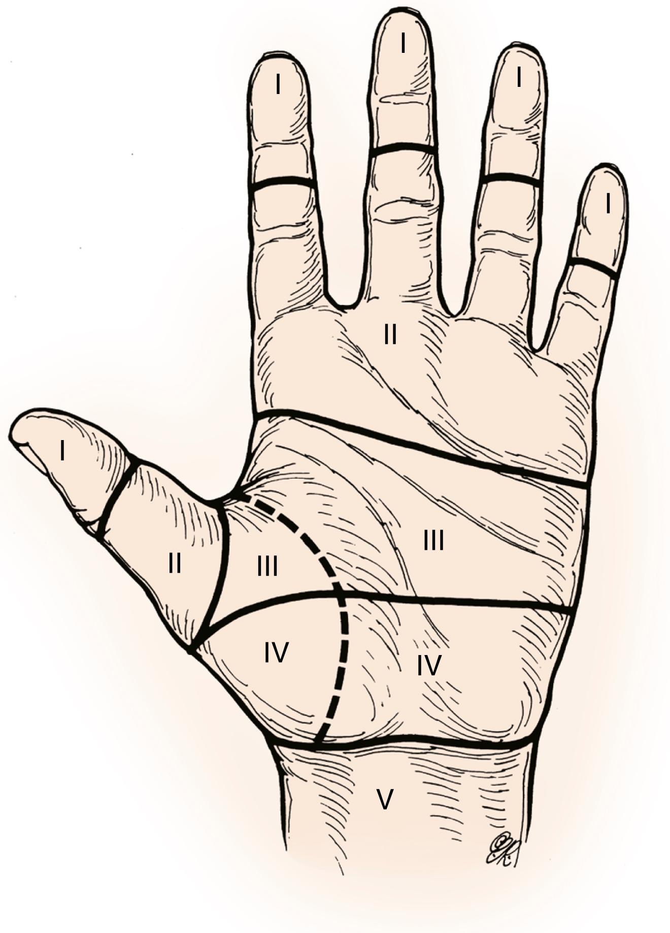 Fig. 6.2, Flexor system has been divided into five zones or levels for the purposes of discussion and treatment. Zone 2, which lies within the fibroosseous sheath, has been called “no man’s land” because it was previously believed that primary repair should not be done in this zone.