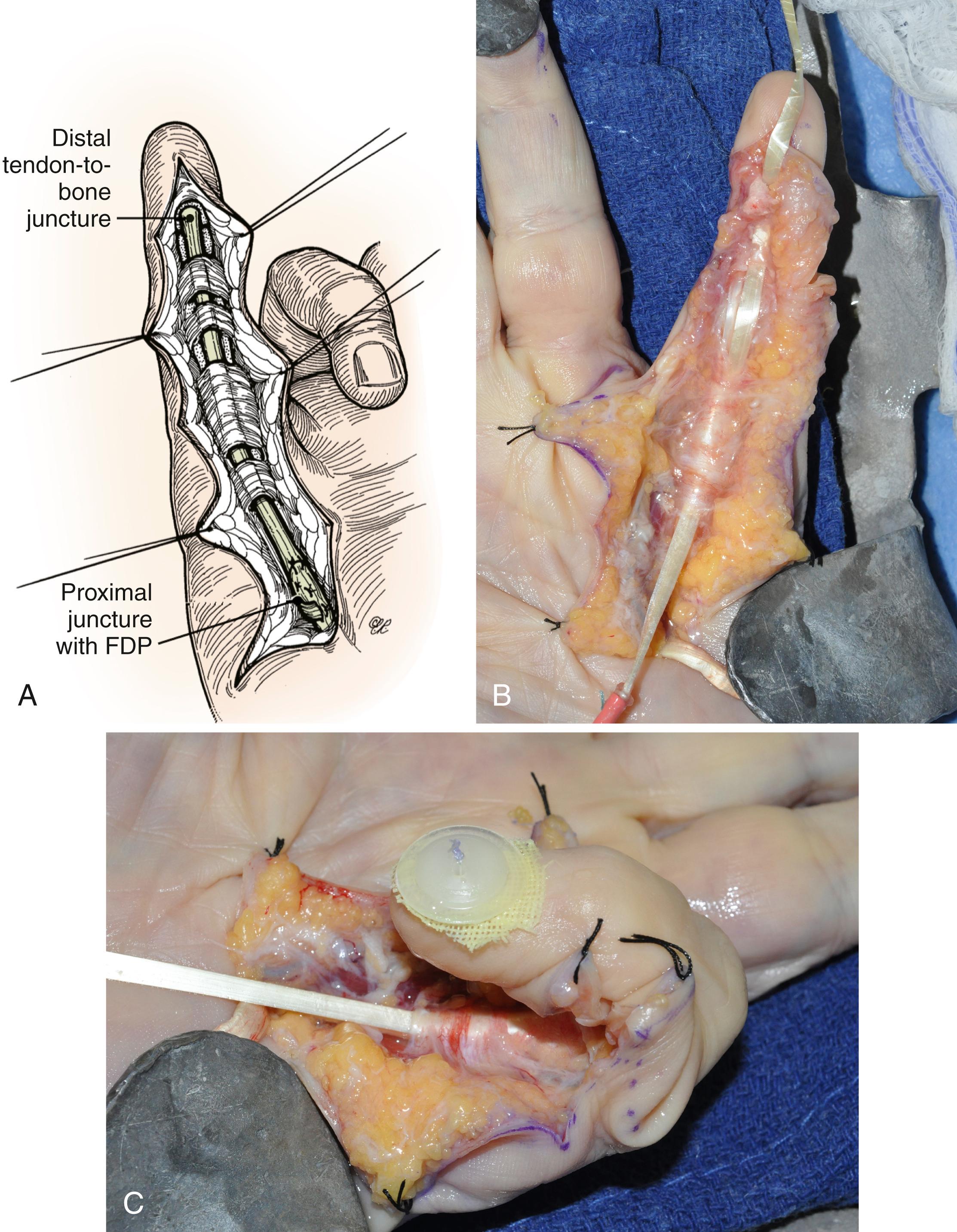 Fig. 6.24, A, Flexor tendon graft. Tendon junctures are placed outside the confines of the flexor sheath (zone 2). B, In this clinical case, the graft has been passed from distal to proximal using a red-rubber catheter beneath the intact pulley system. C, Following distal junction repair with an “around-the-bone” pull-out suture, the graft is tensioned before the proximal juncture.