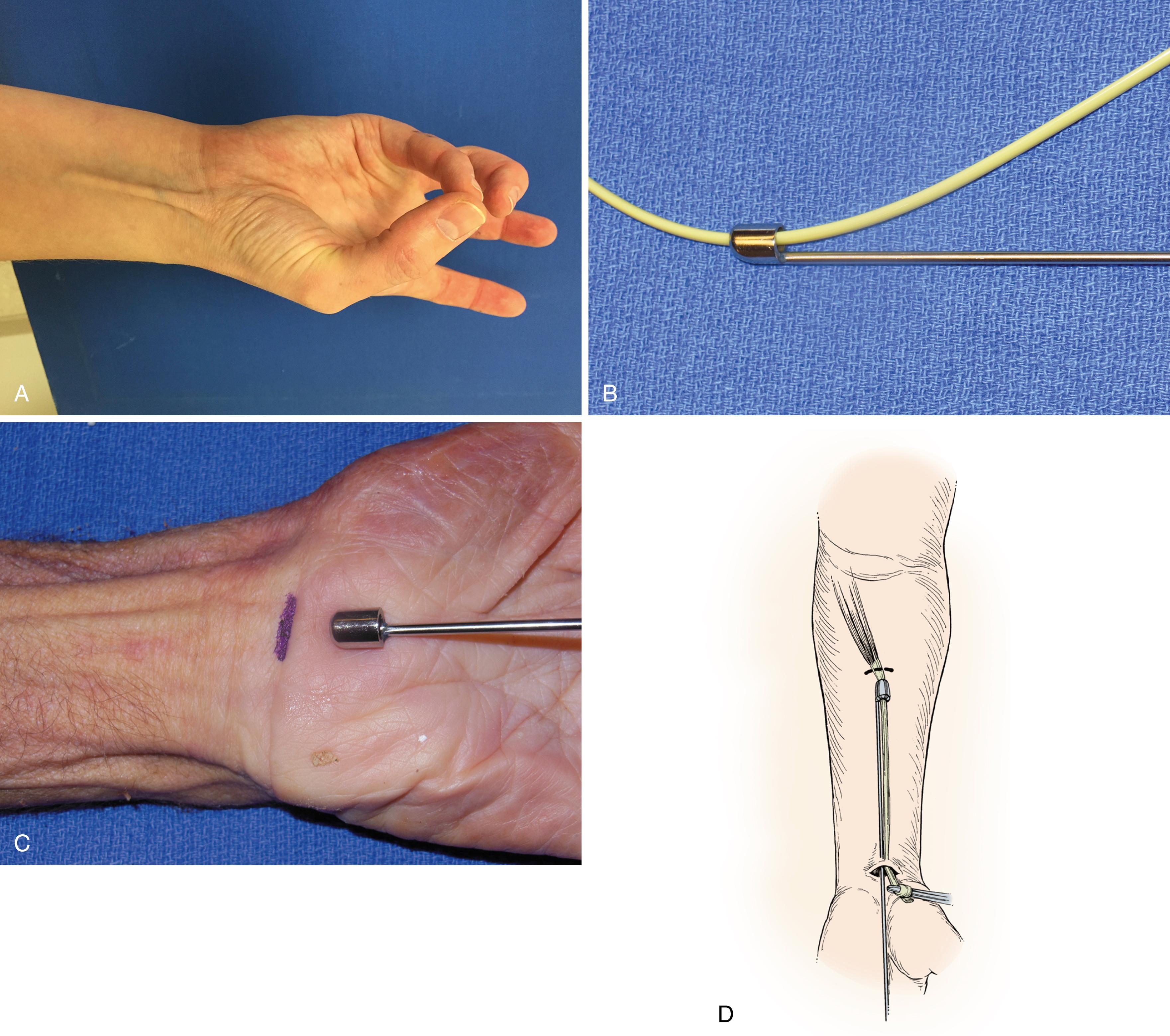 Fig. 6.25, Palmaris longus graft. A, Identification of the palmaris longus using the Schaeffer test. B, Our preferred technique for obtaining the graft uses a tendon stripper, which is a circular knife passed along the surface of the tendon. C, Placement of stripper. D, Stripper is advanced until it cuts off the graft at the muscle belly, or a second proximal incision can be used to obtain the proximal end of the tendon graft.