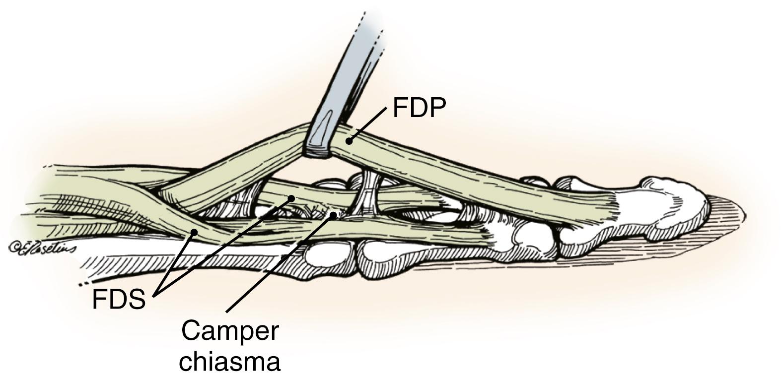 Fig. 6.3, In the proximal part of the flexor sheath, FDS tendon divides into two slips, which encircle the FDP tendon first at the volar aspect, then at the radial and ulnar aspects, and finally at the dorsal aspect. The two portions of the FDS tendon reunite at the Camper chiasm and redivide before inserting onto the middle three-fifths of the volar aspect of the middle phalanx, forming the floor of the flexor sheath in this area.