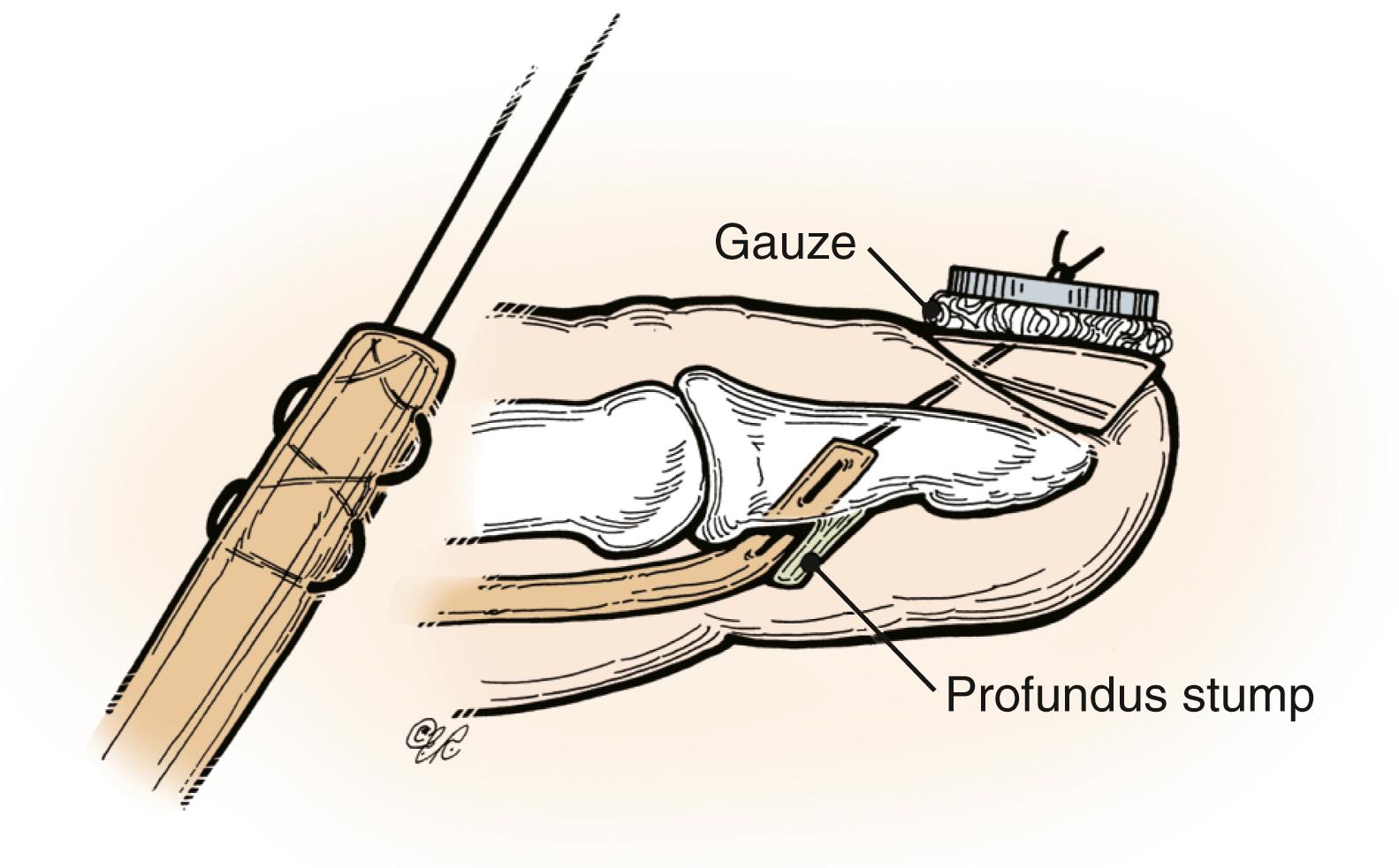 Fig. 6.6, Modified Bunnell distal juncture technique. Pull-out sutures are passed through the distal phalanx.